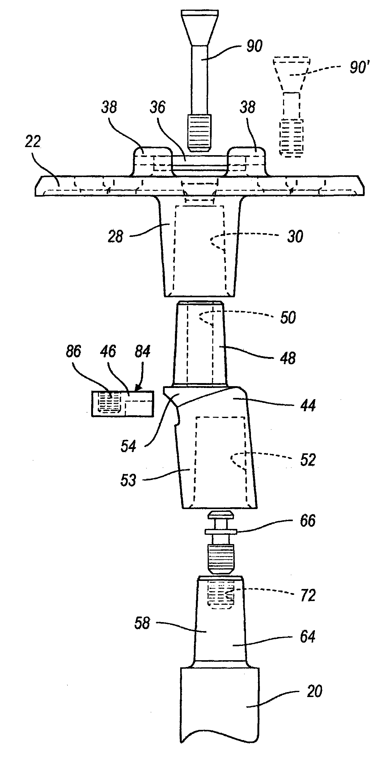 Knee joint prosthesis system and method for implantation