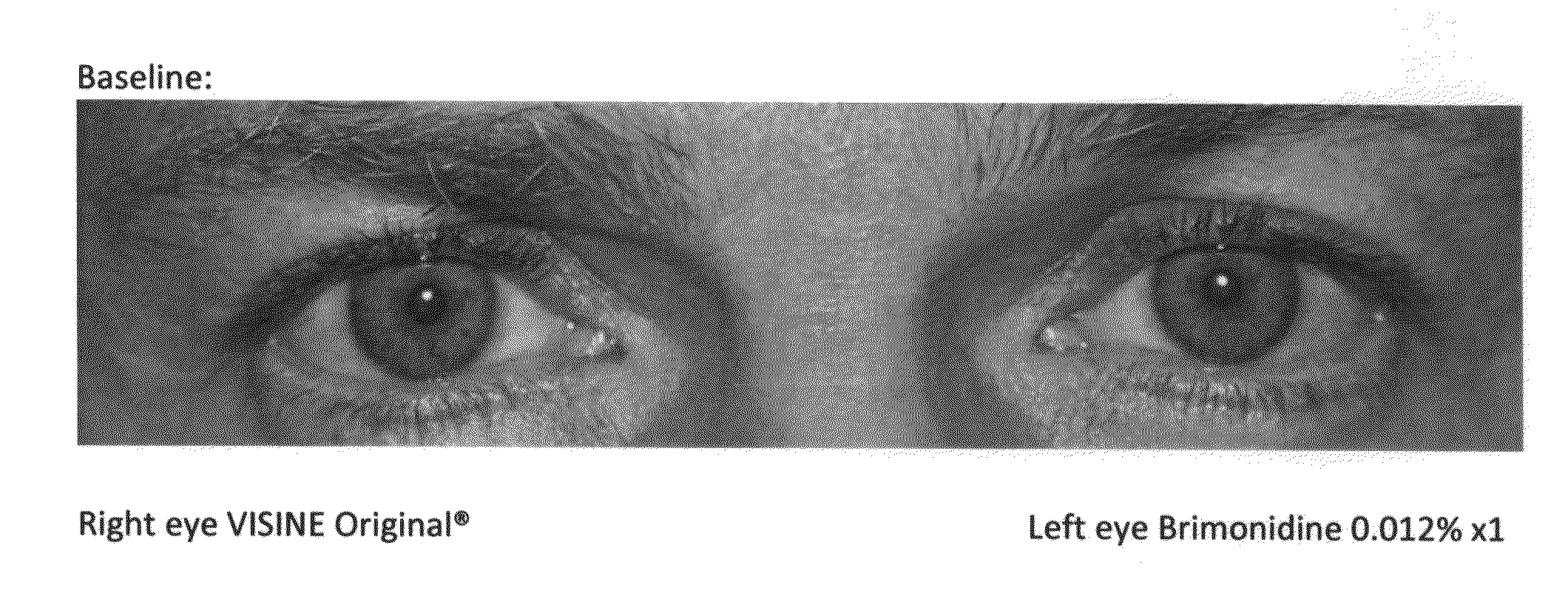 Compositions and methods for treatment of diseases and conditions associated with vasodilation and/or vascular leakage