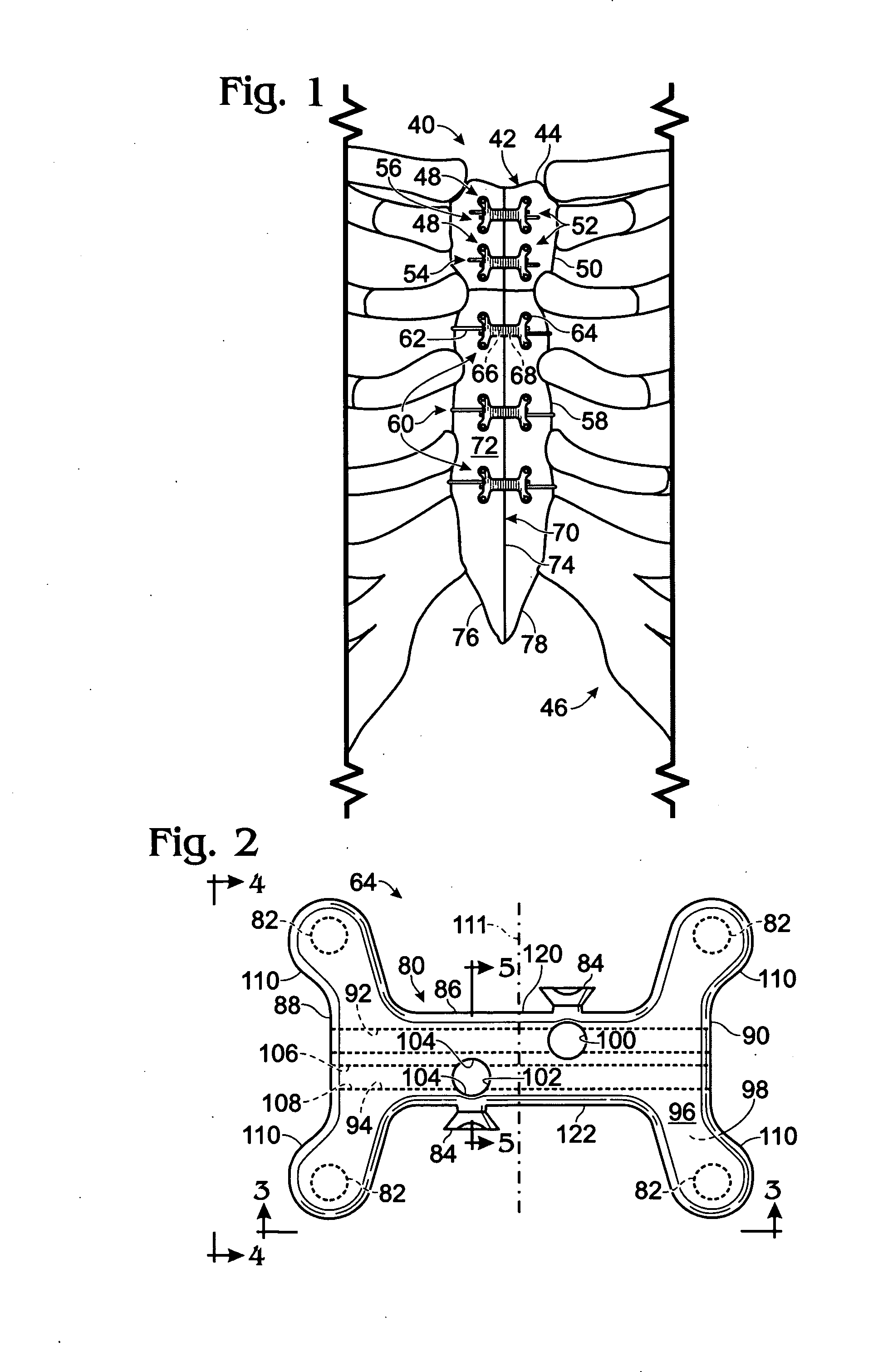 Cerclage system for bone