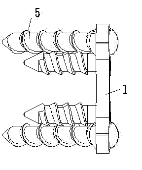 Lower cervical spine anterior pedicle screw matching, fixing and retaining device