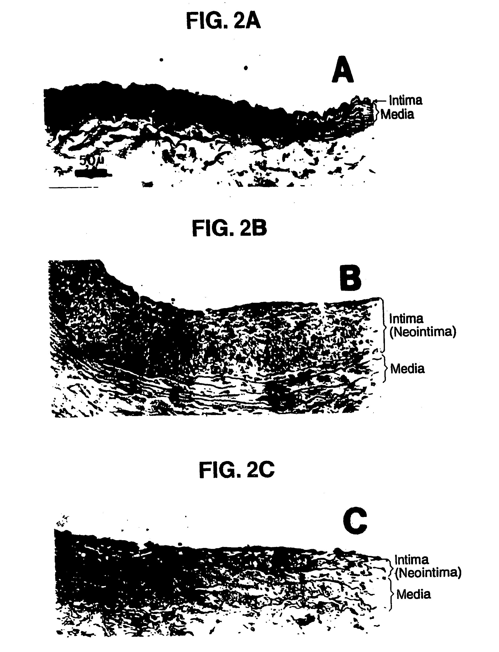 Method for treating atherosclerosis or restenosis using microtubule stabilizing agent