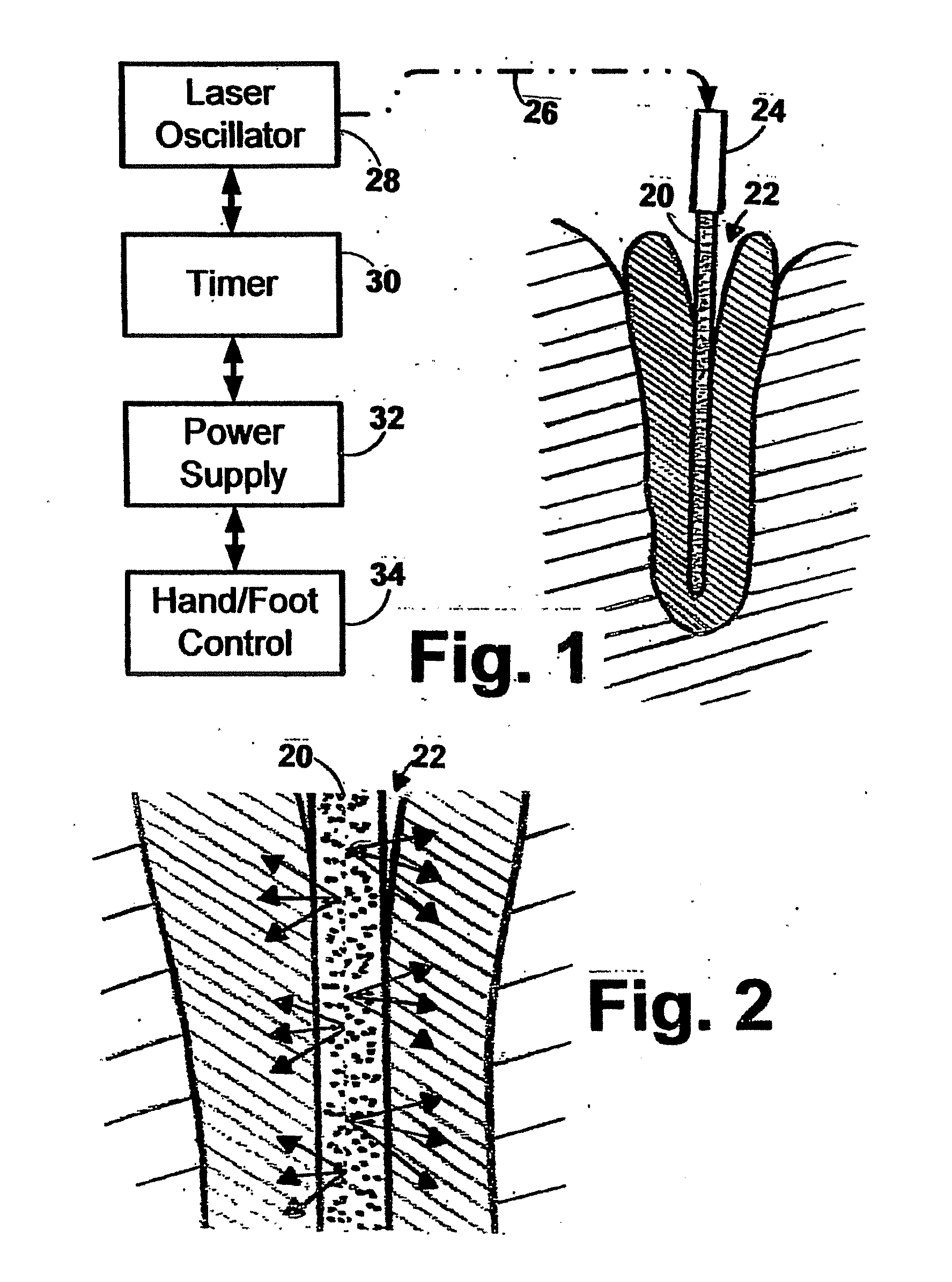 Instrument for Delivery of Optical Energy to the Dental Root Canal System for Hidden Bacterial and Live Biofilm Thermolysis