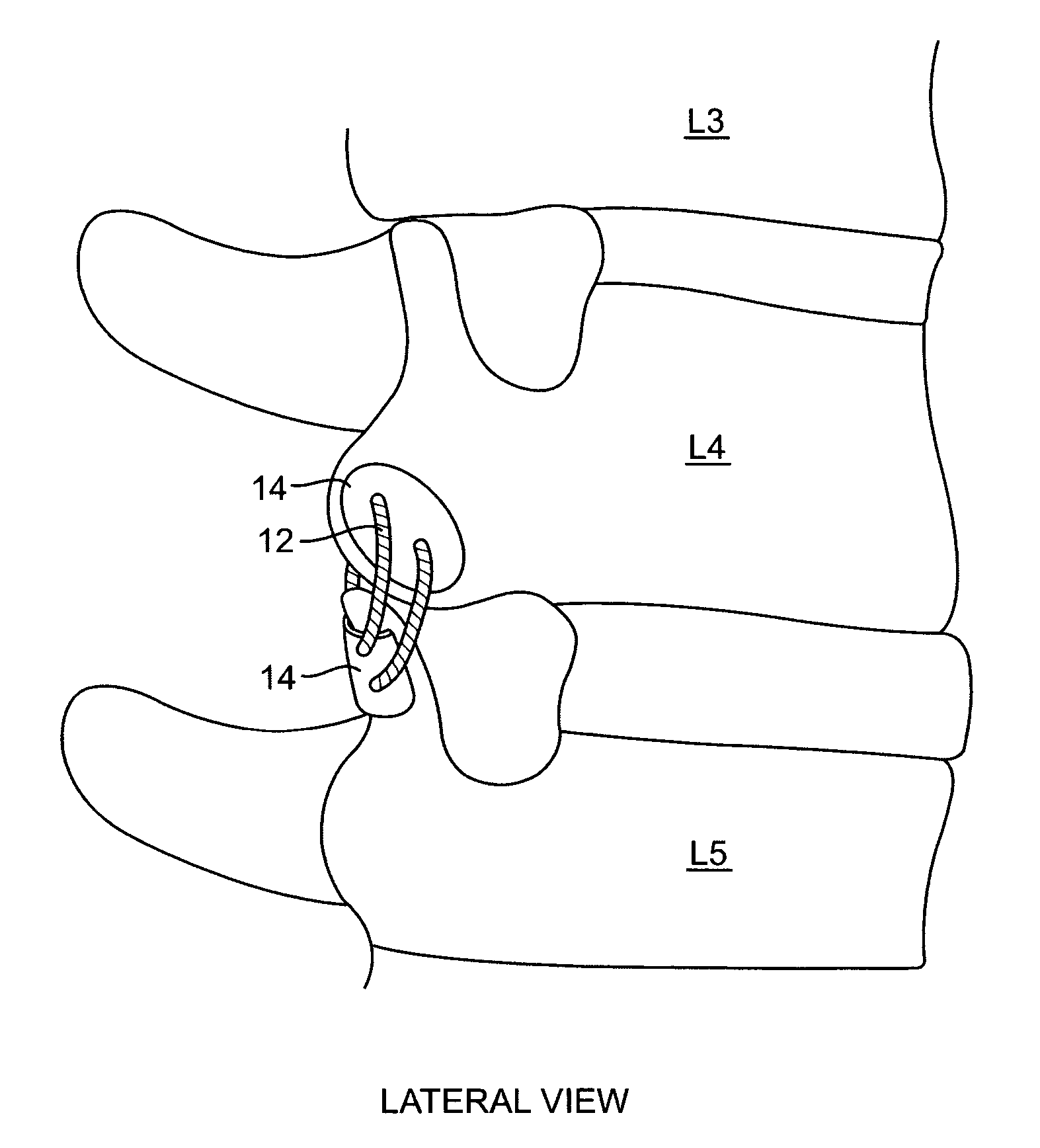 Facet joint fusion devices and methods