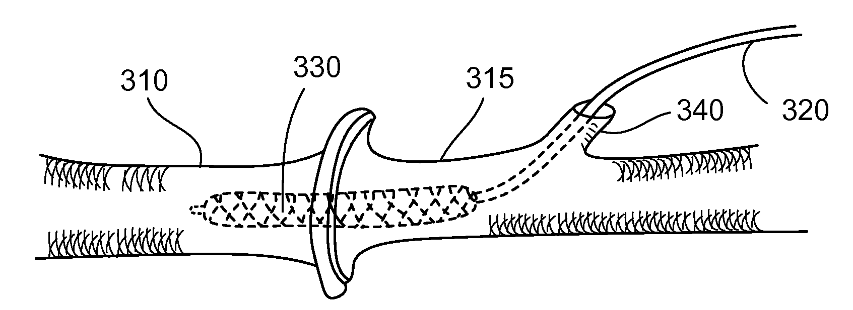 Method and Apparatus for Vascular Anastomosis