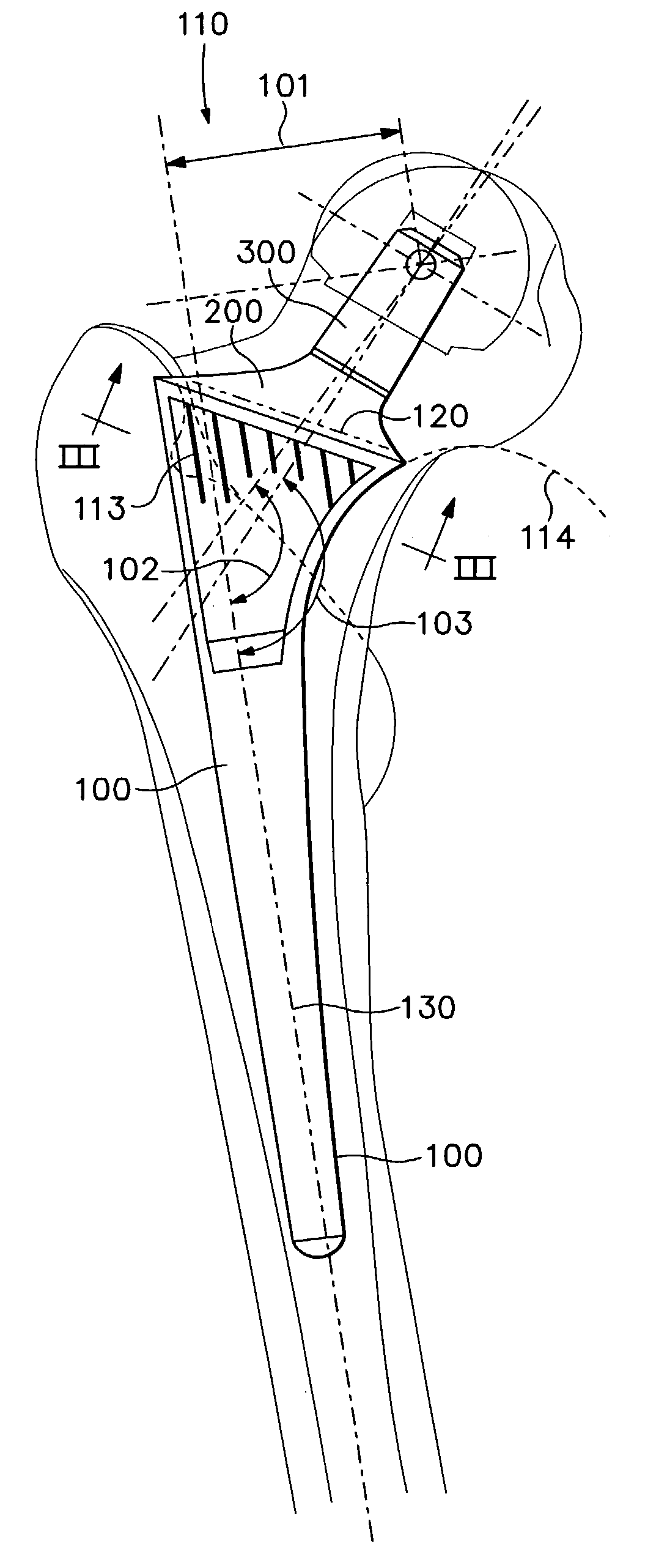 Neck-preserving-stem NPS