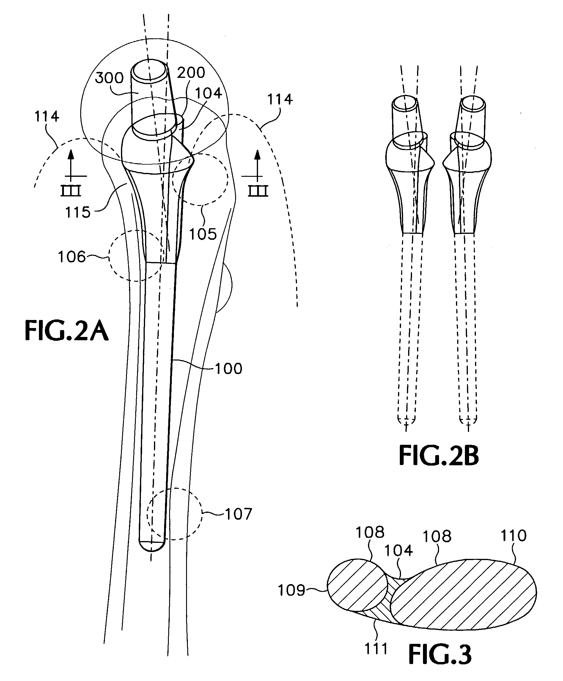 Neck-preserving-stem NPS