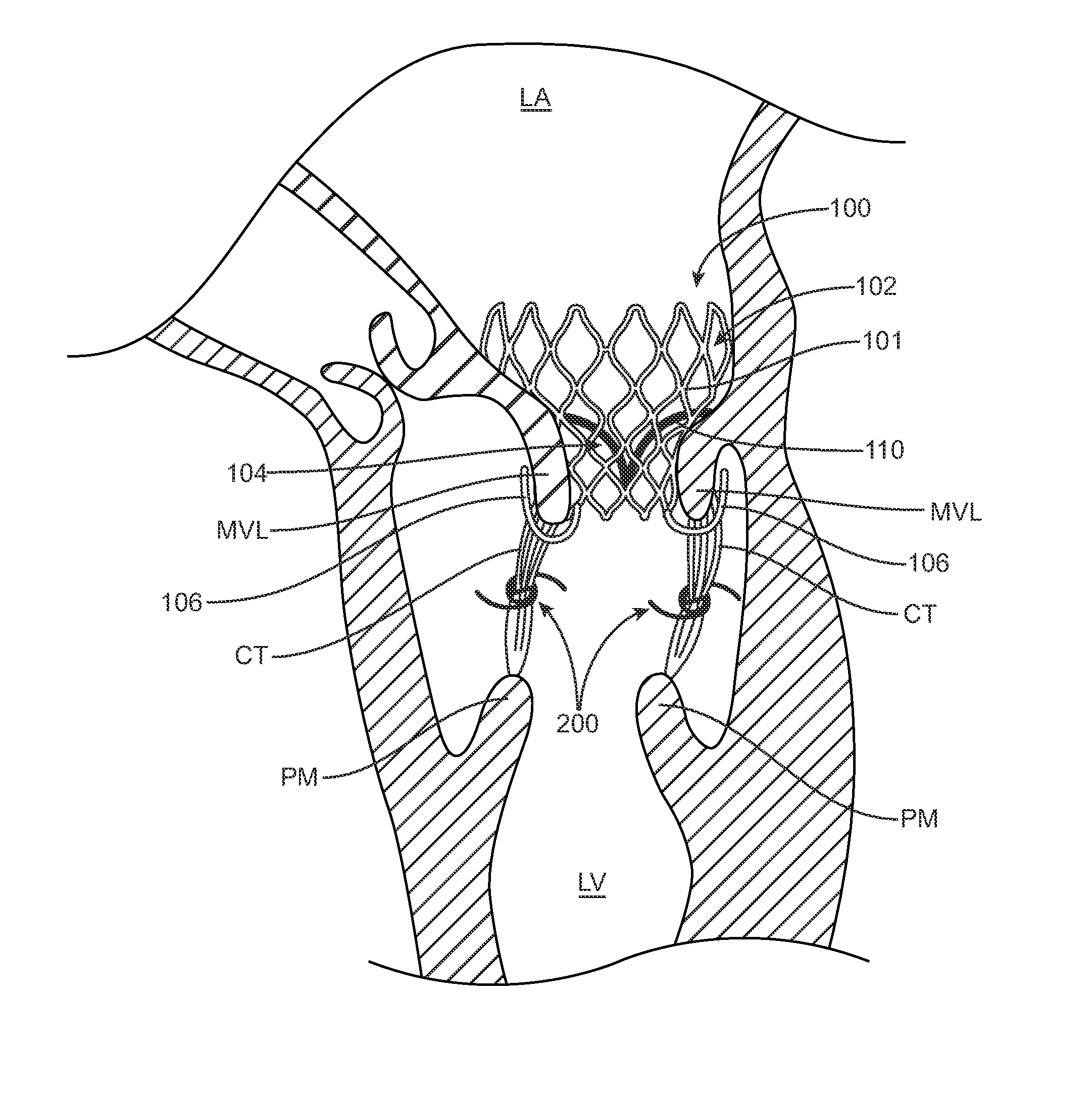 Method of Treating Paravalvular Leakage After Prosthetic Valve Implantation