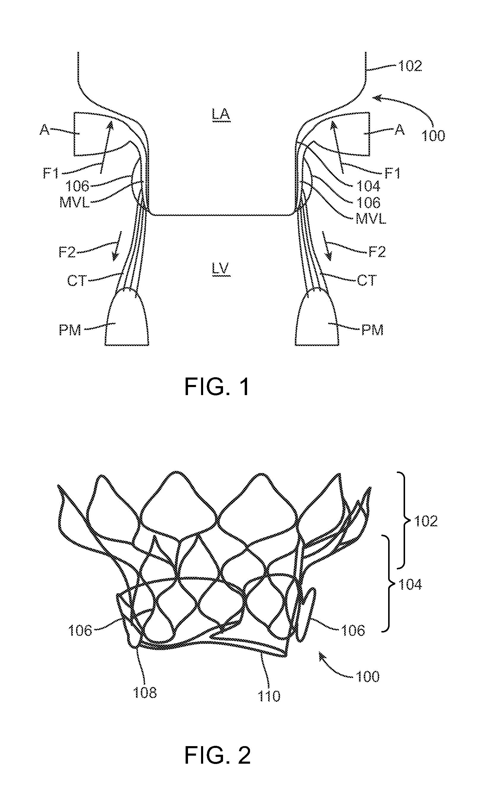 Method of Treating Paravalvular Leakage After Prosthetic Valve Implantation