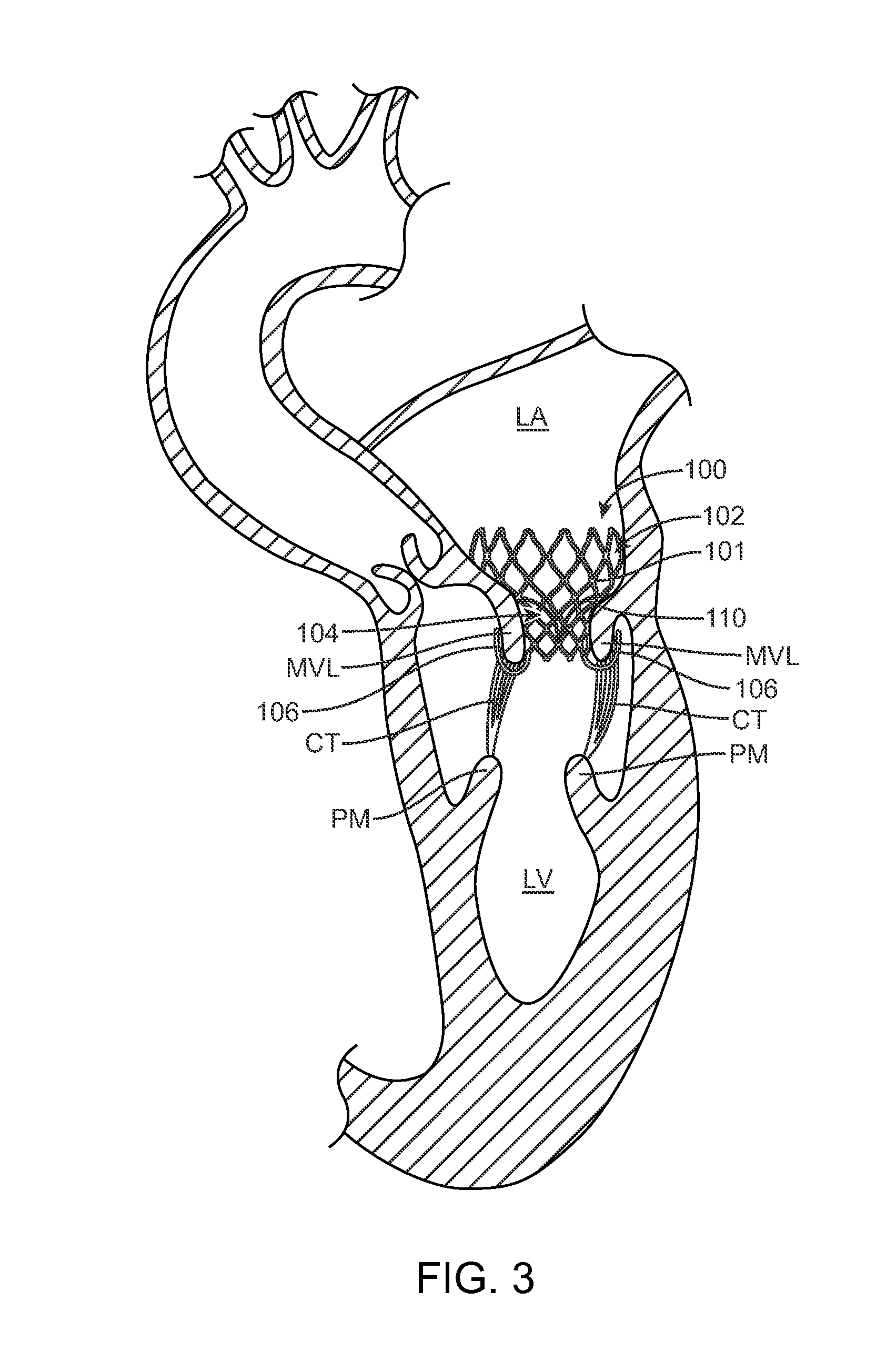 Method of Treating Paravalvular Leakage After Prosthetic Valve Implantation