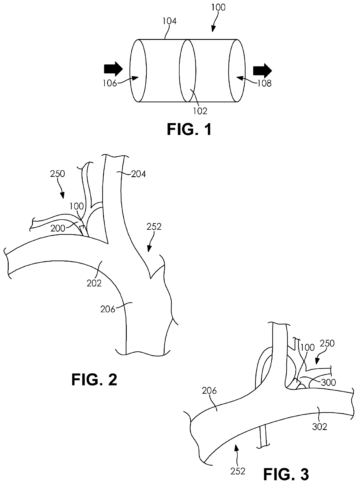 Devices and Methods for Treating Congestive Heart Failure, Ascites, and Other Disorders Relating to Excess Bodily Fluid