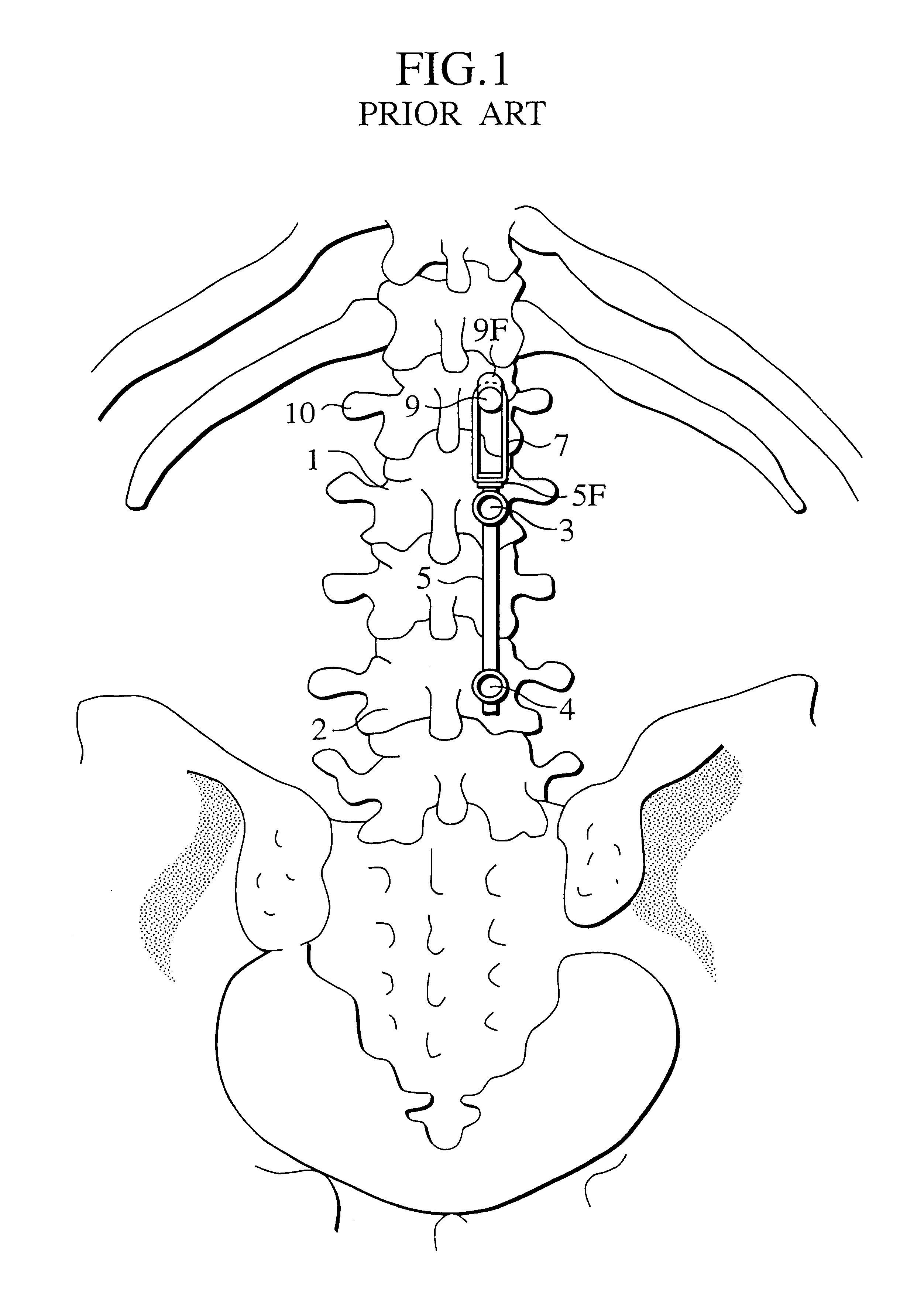 Implant for bone connector