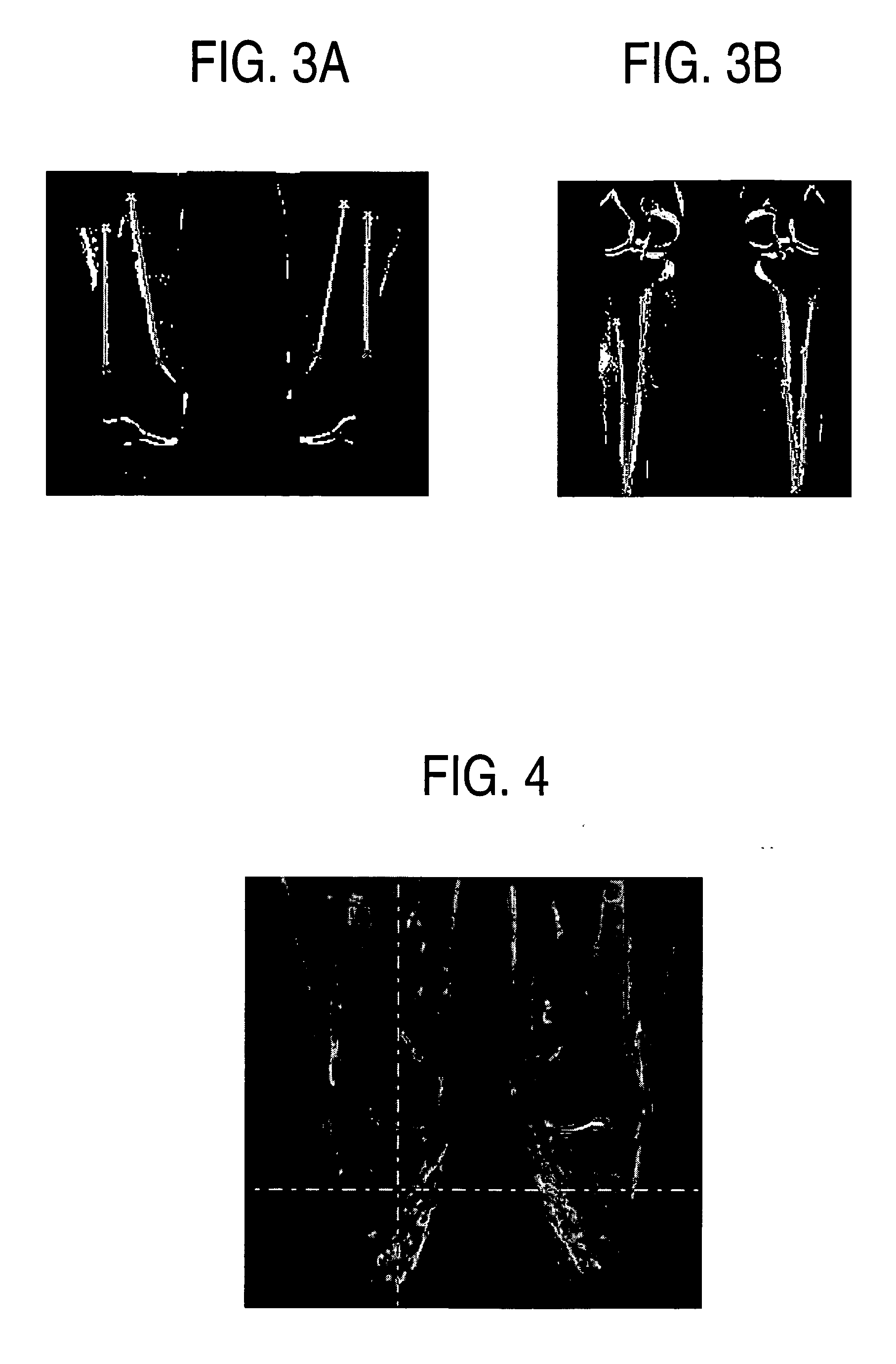 Automatic bone detection in MRI images