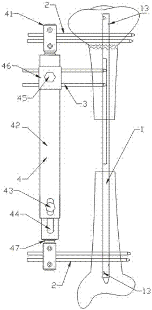 Bone carrying device for large segmental bone defect of tibia