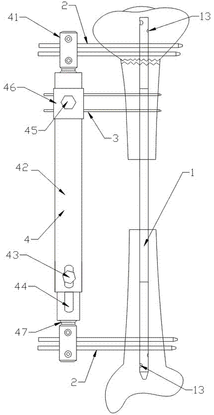 Bone carrying device for large segmental bone defect of tibia