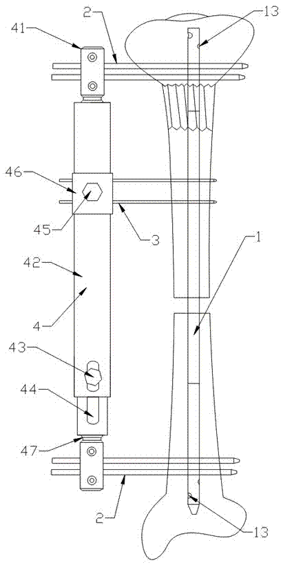 Bone carrying device for large segmental bone defect of tibia