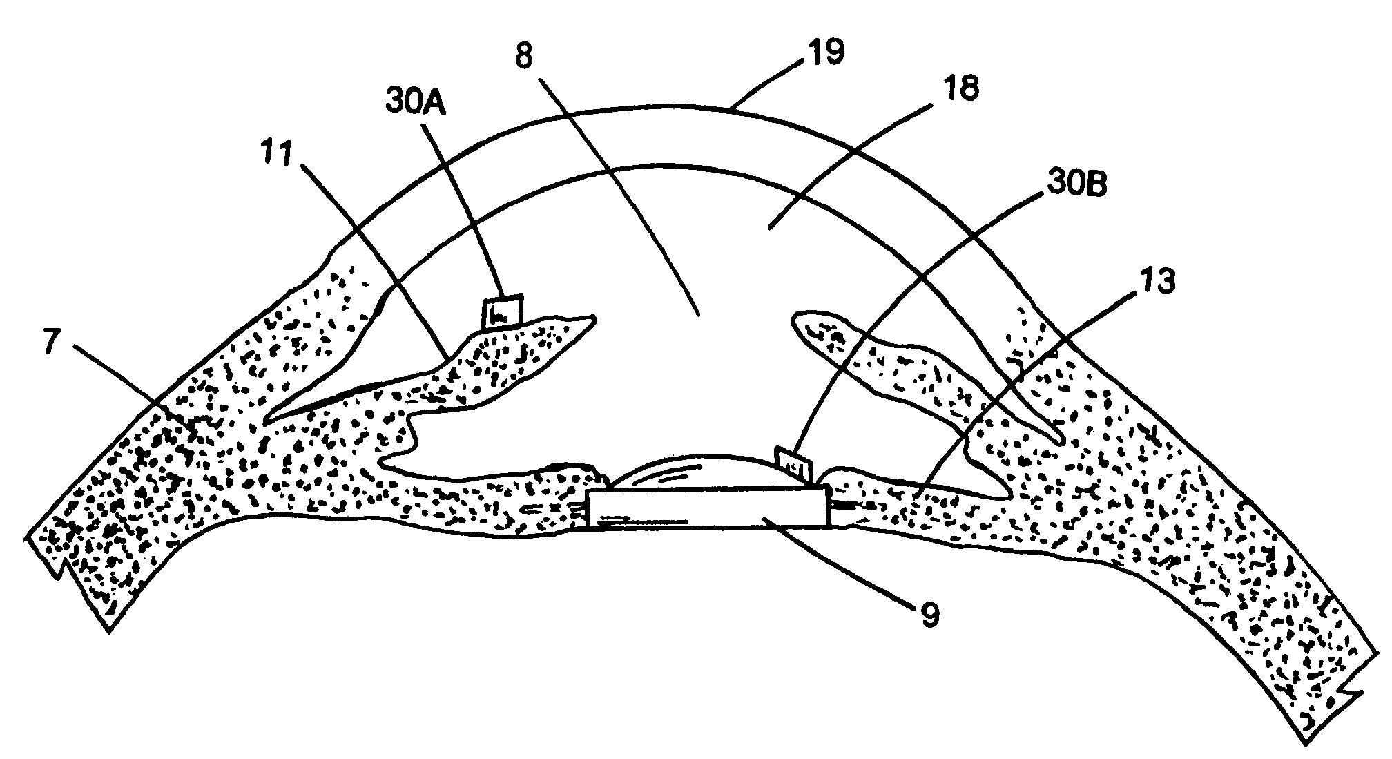 Optically powered and optically data-transmitting wireless intraocular pressure sensor device