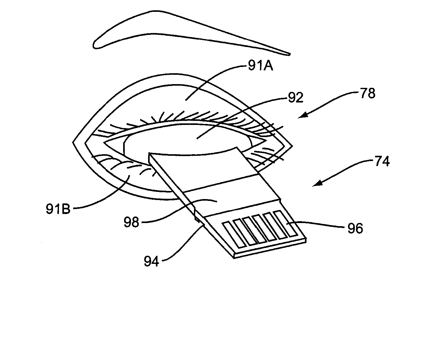 Apparatus for inner eyelid treatment of meibomian gland dysfunction