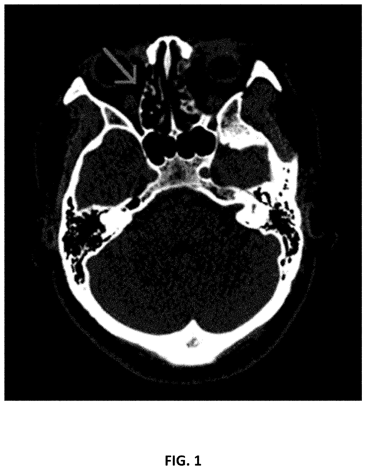 Semi-automated imaging reconstruction for orbital fracture repair