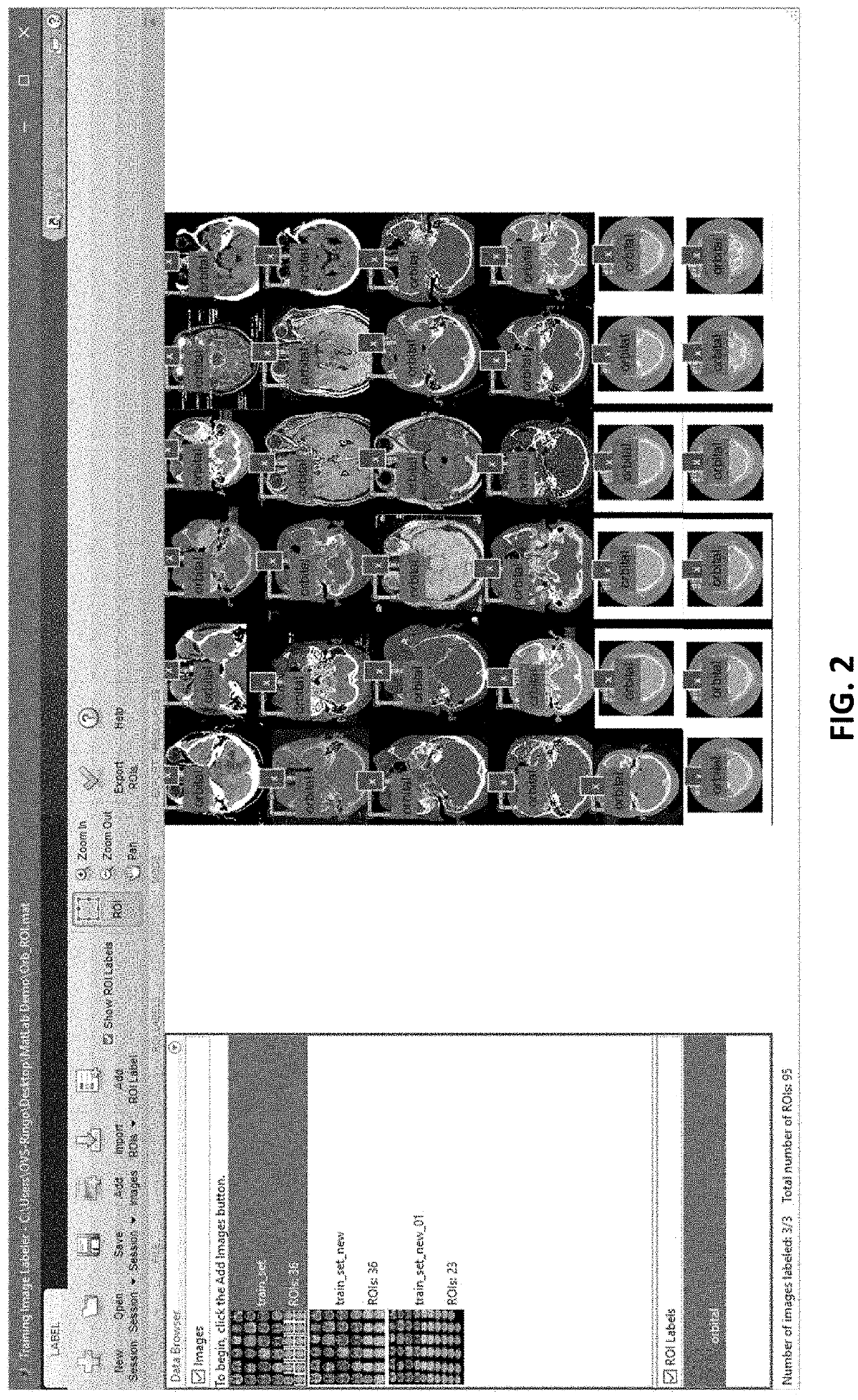 Semi-automated imaging reconstruction for orbital fracture repair