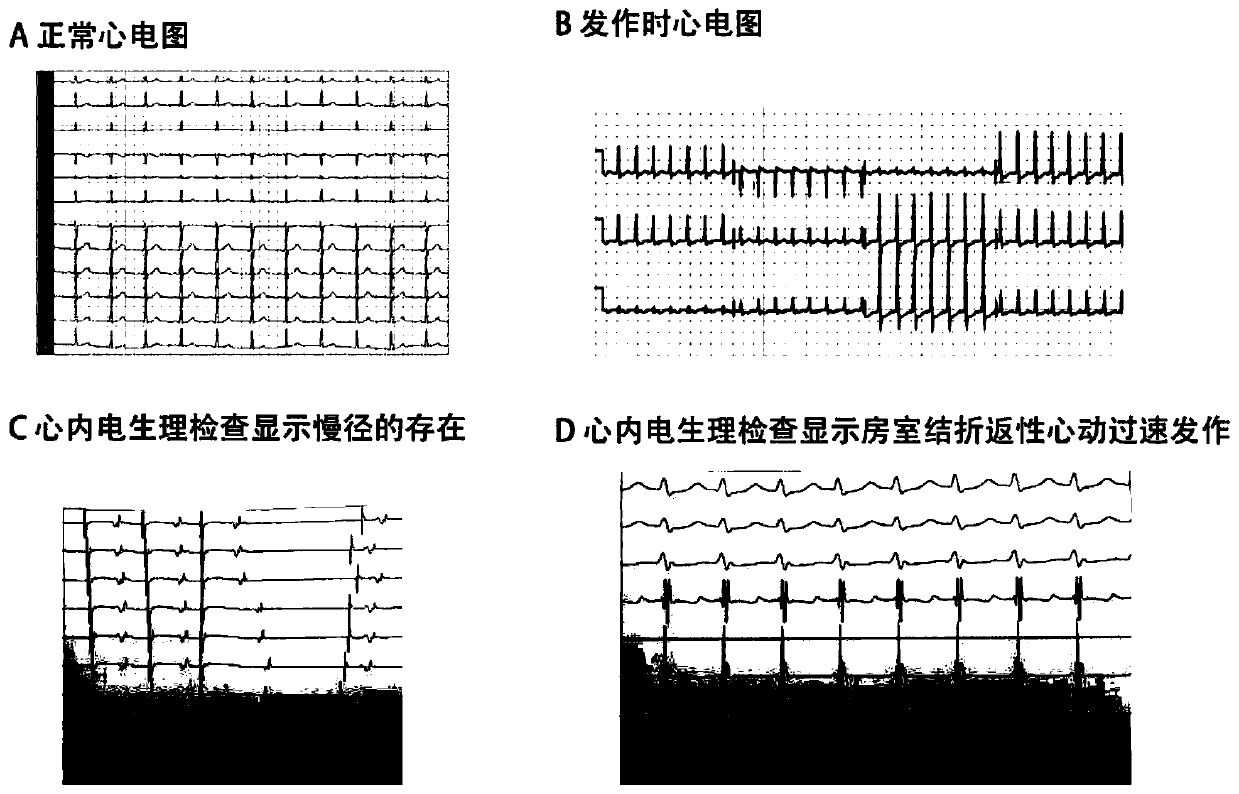 Screening kit for paroxysmal supraventricular tachycardia