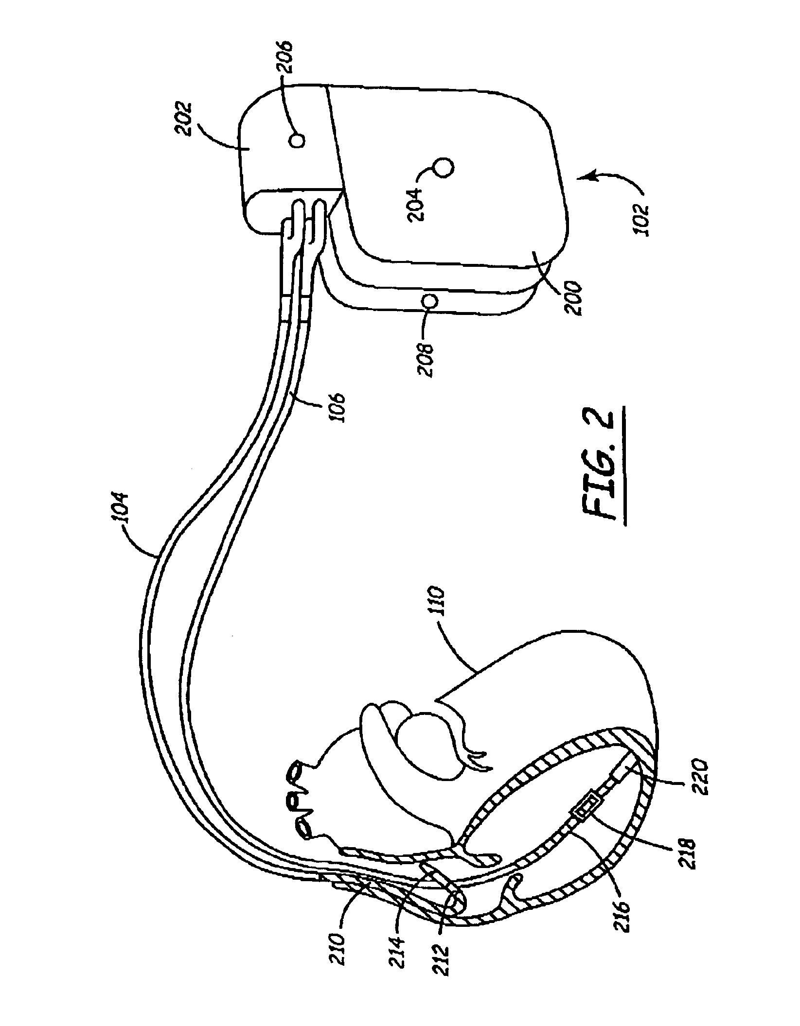 Implantable medical device (IMD) system configurable to subject a patient to a stress test and to detect myocardial ischemia within the patient