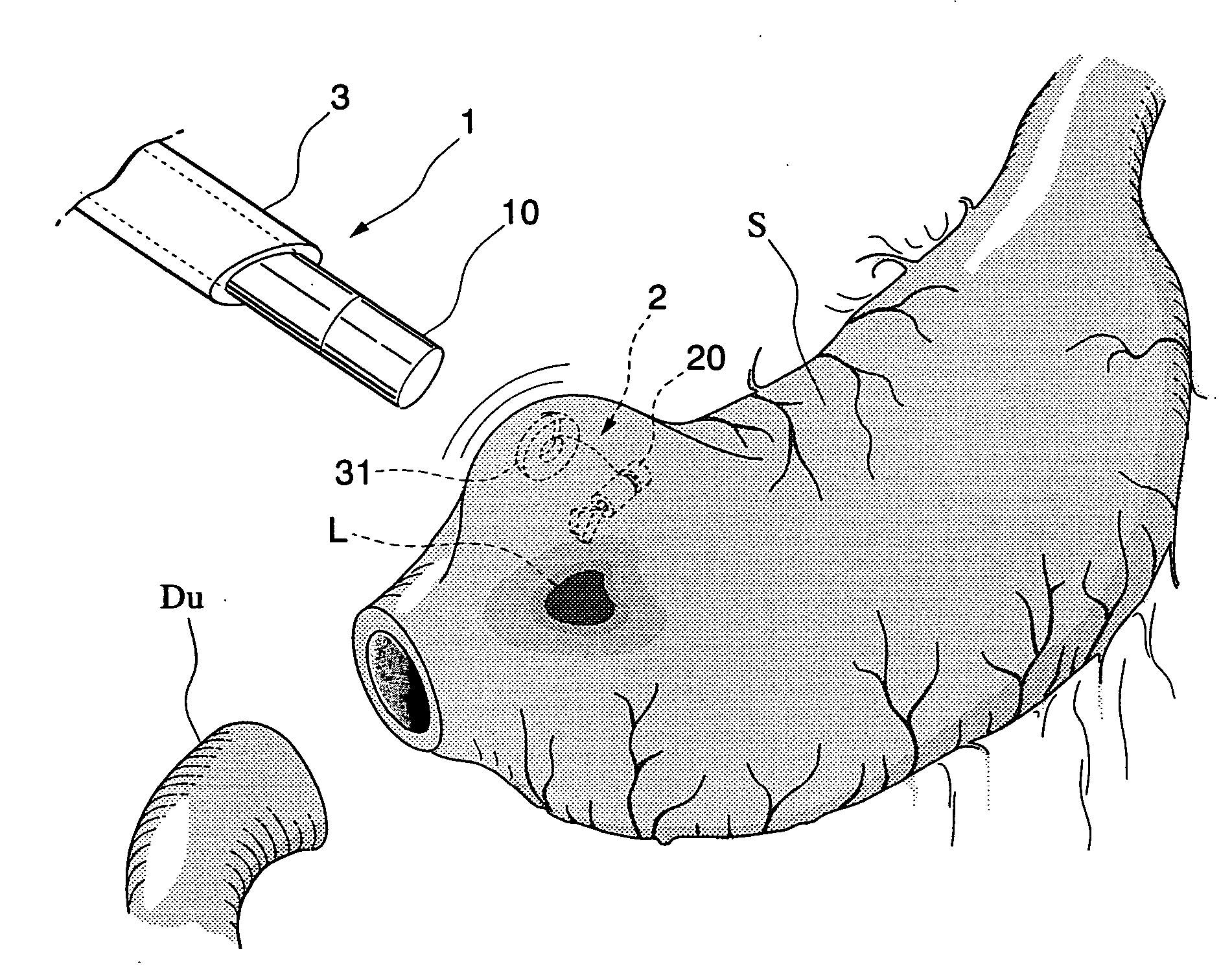 Probing method and holding method for lumenal organ