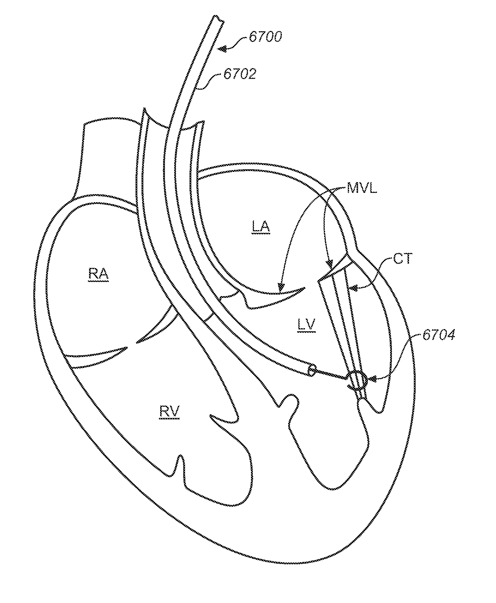 Diagnostic catheters, guide catheters, visualization devices and chord manipulation devices, and related kits and methods