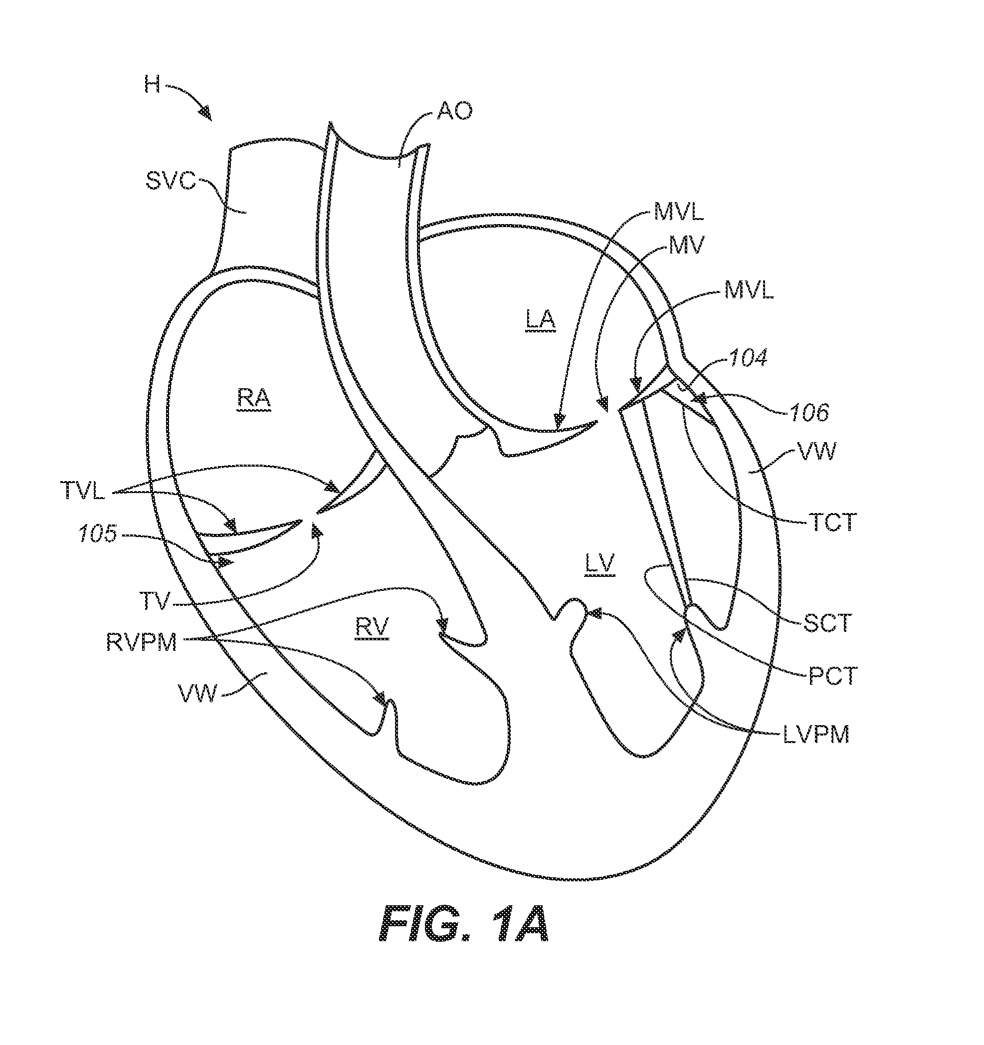 Diagnostic catheters, guide catheters, visualization devices and chord manipulation devices, and related kits and methods