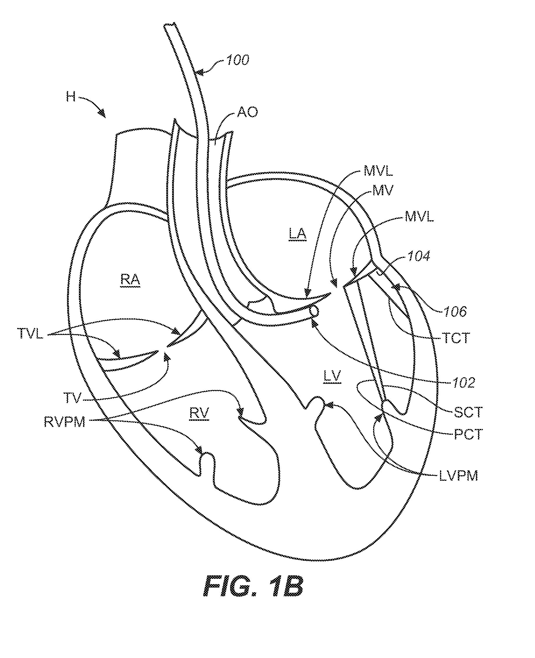 Diagnostic catheters, guide catheters, visualization devices and chord manipulation devices, and related kits and methods