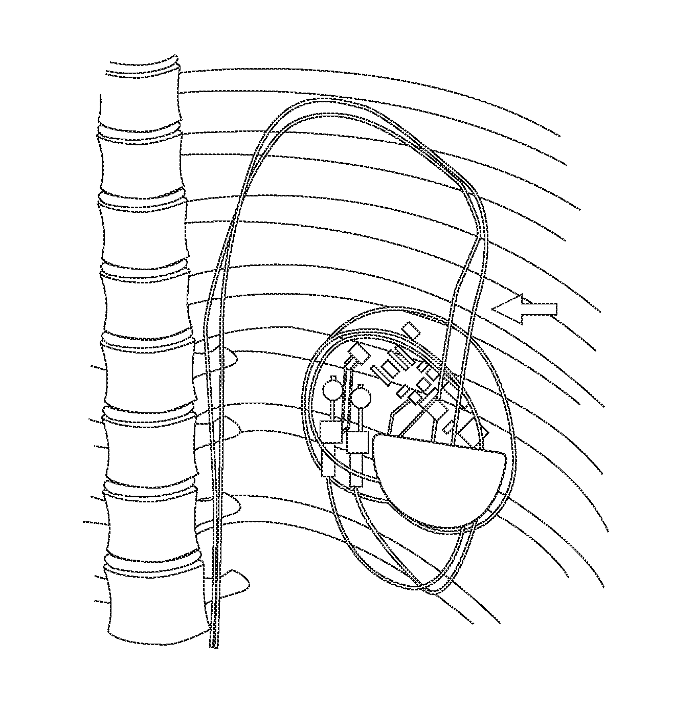 Methods and Apparatus for Detecting and Localizing Partial Conductor Failures of Implantable Device Leads