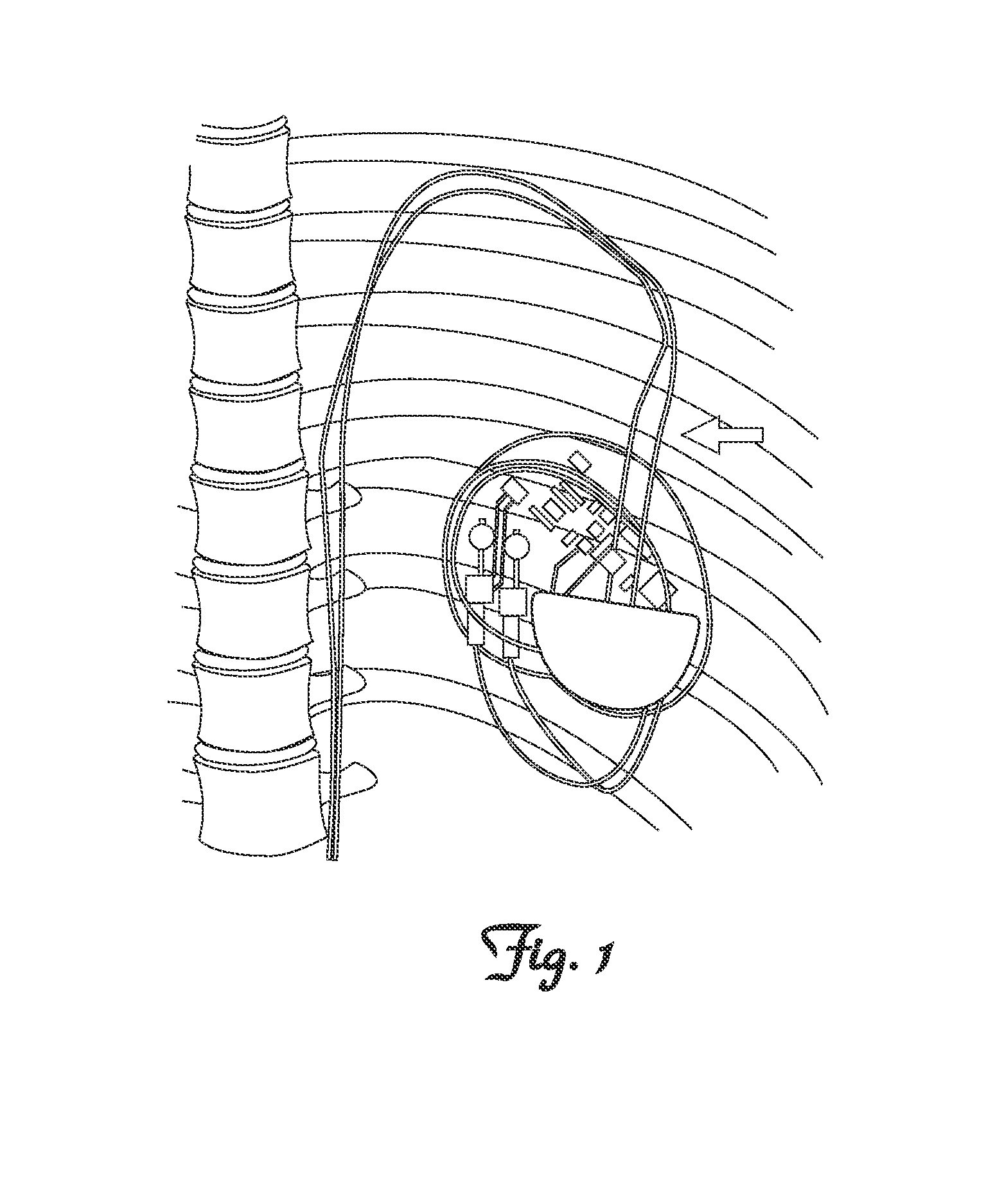 Methods and Apparatus for Detecting and Localizing Partial Conductor Failures of Implantable Device Leads