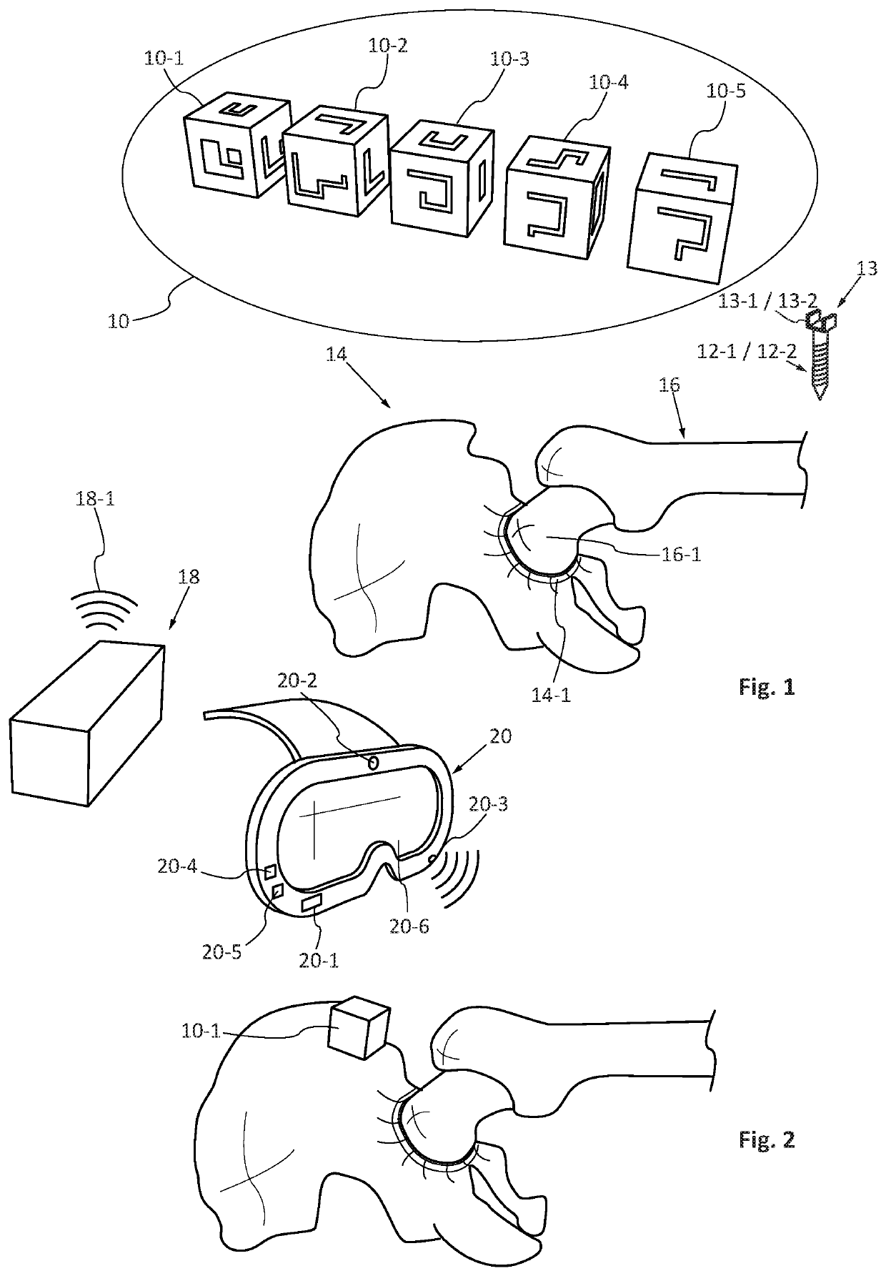 Method and device for assisting a surgeon fit a prosthesis, in particular a hip prosthesis, following different surgical protocols