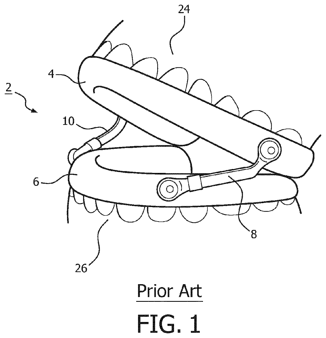 Mandibular advancement device and method of adjusting a dimension of a coupling assembly of a mandibular advancement device