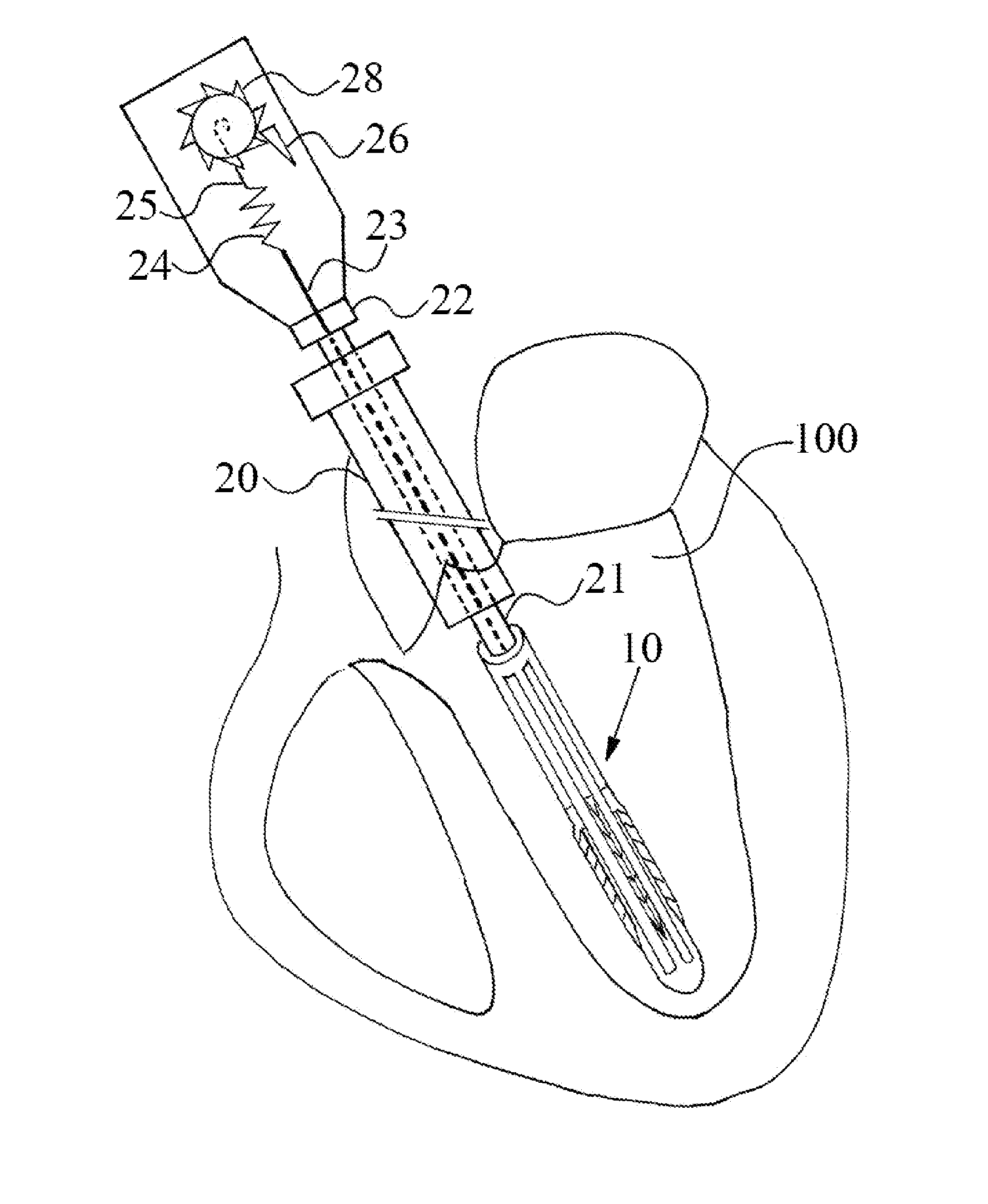 System for restoring cardiac muscular asynchronized contraction manner in a failing heart