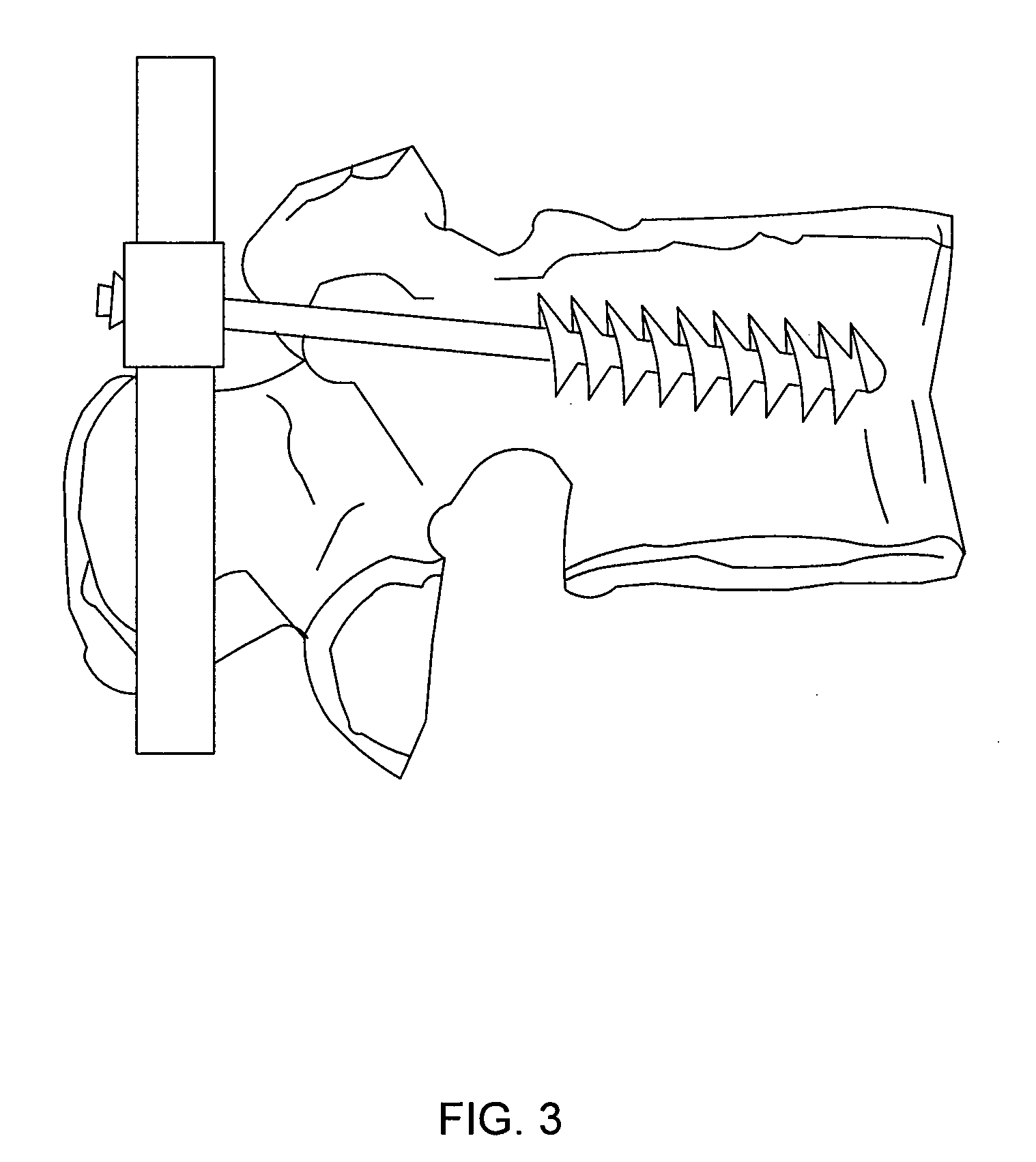 Bone screw system and method for the fixation of bone fractures