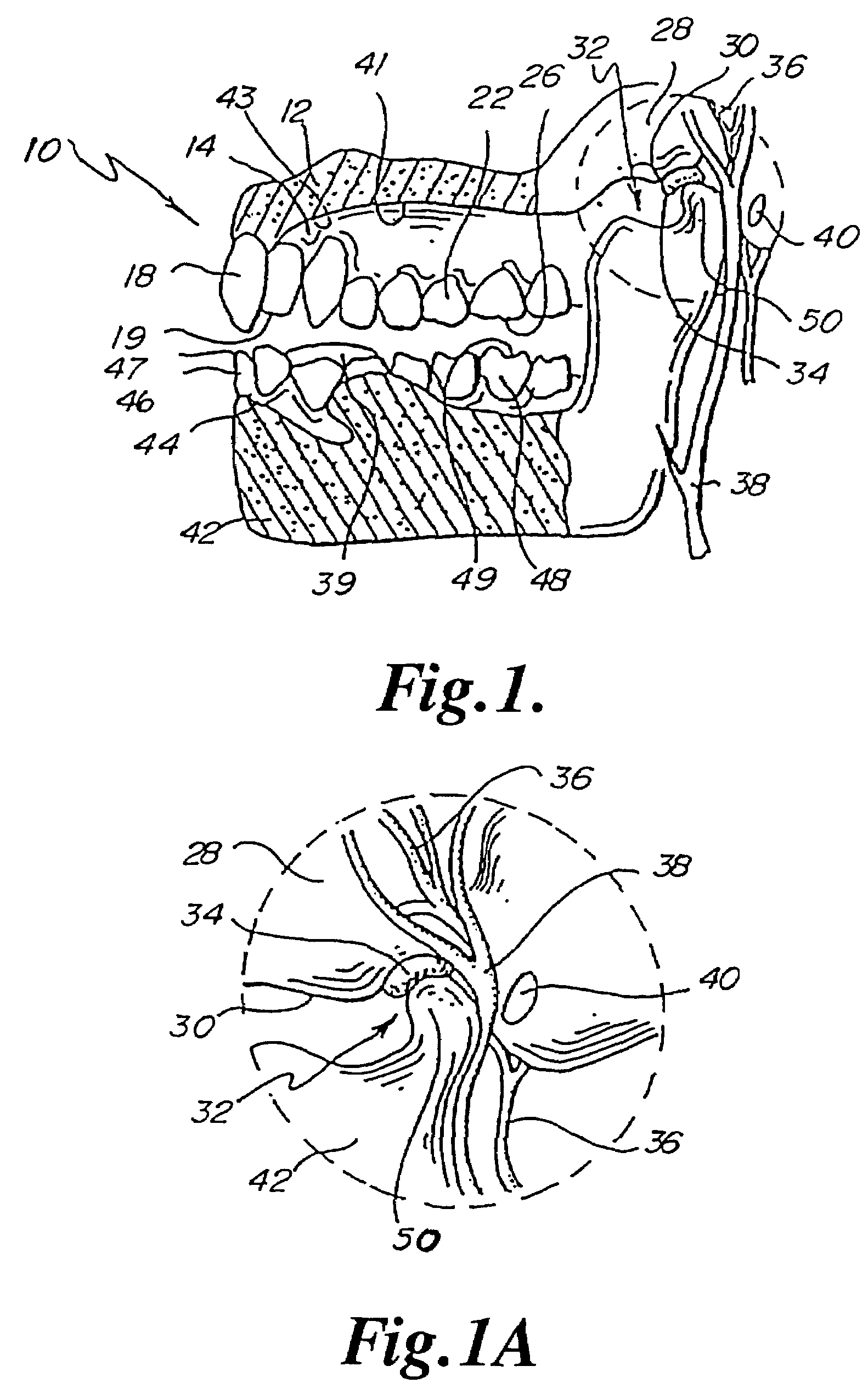 Three part composite performance enhancing mouthguard