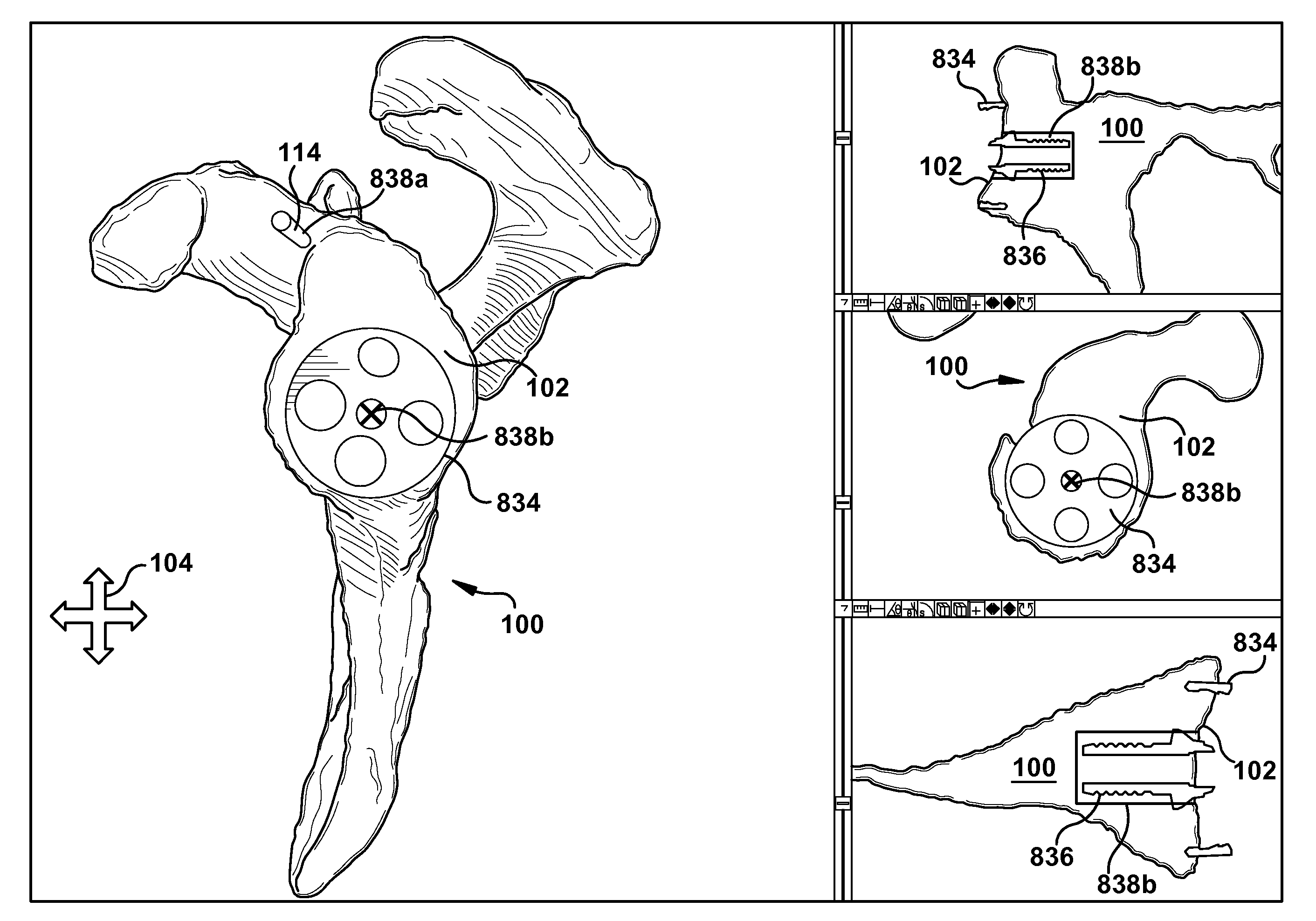 System and method for association of a guiding aid with a patient tissue