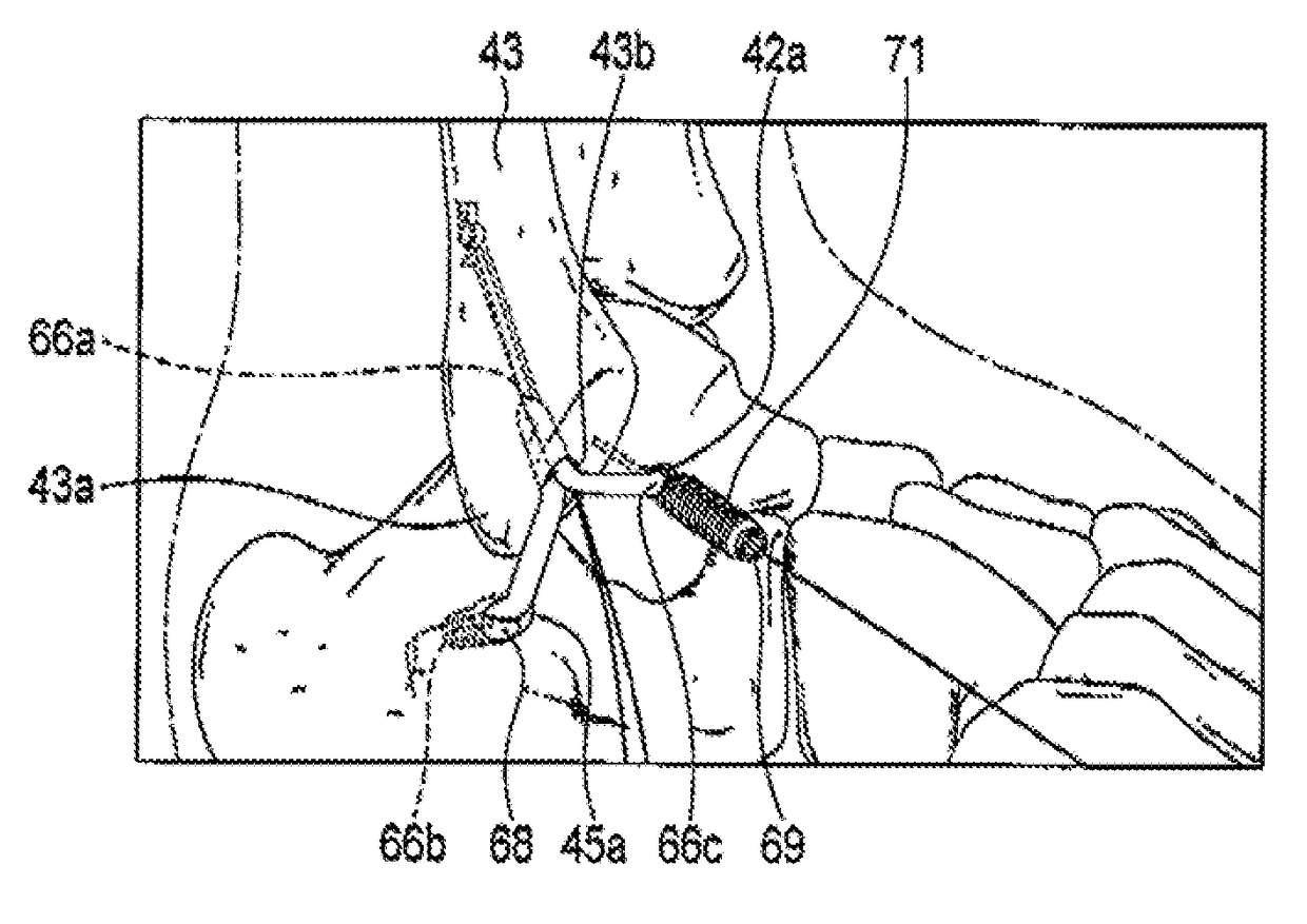 Arthroscopic surgery method for ankle ligament reconstruction