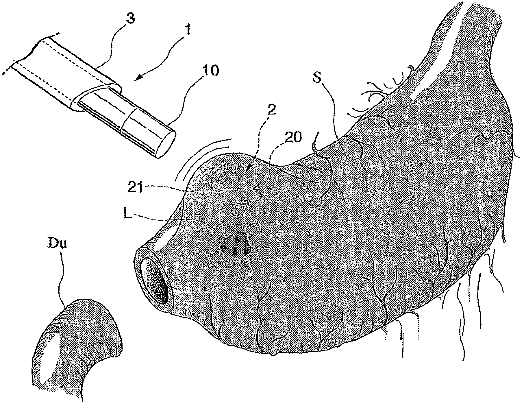 Probing method and holding method for luminal organ