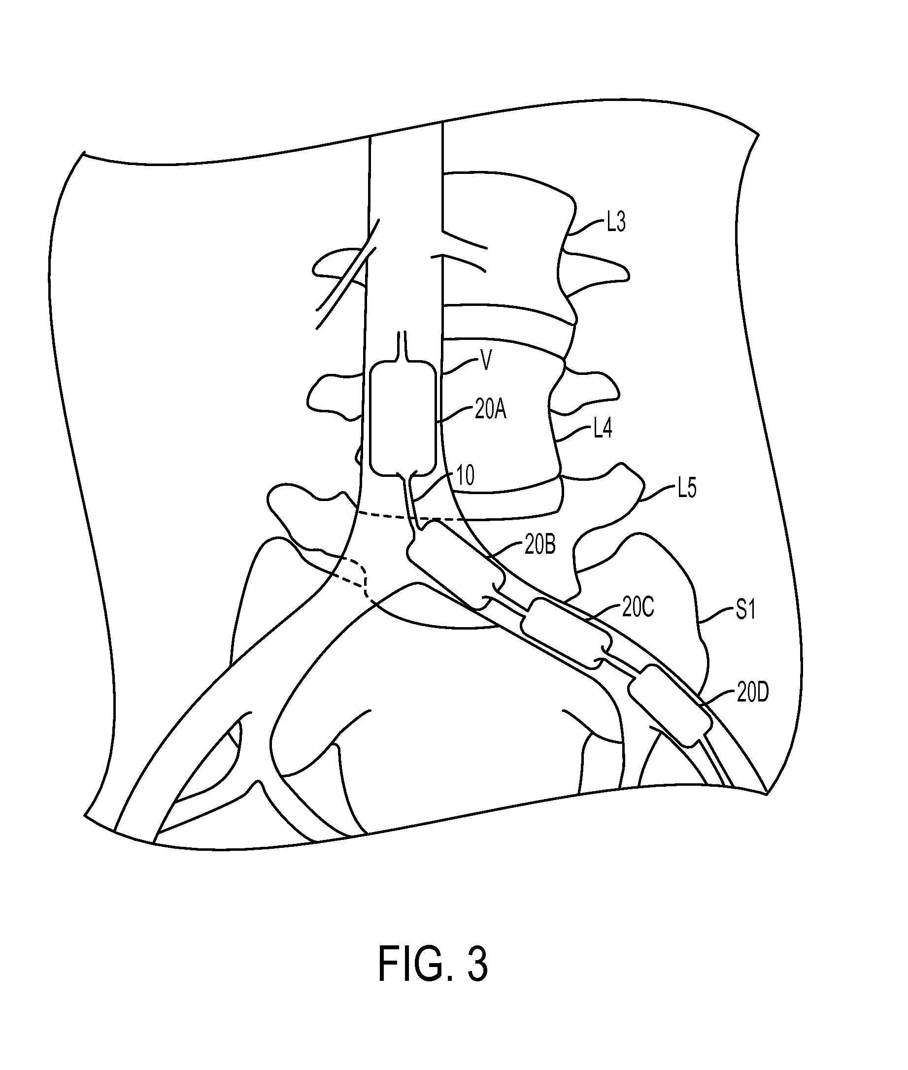 Multiple balloon venous occlusion catheter