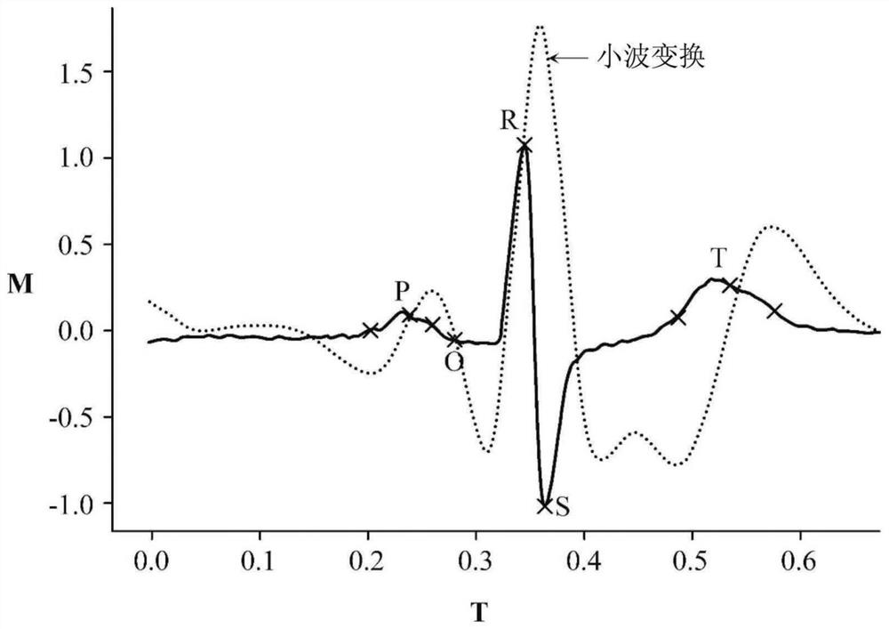 Apparatus and method for analyzing electrocardiogram