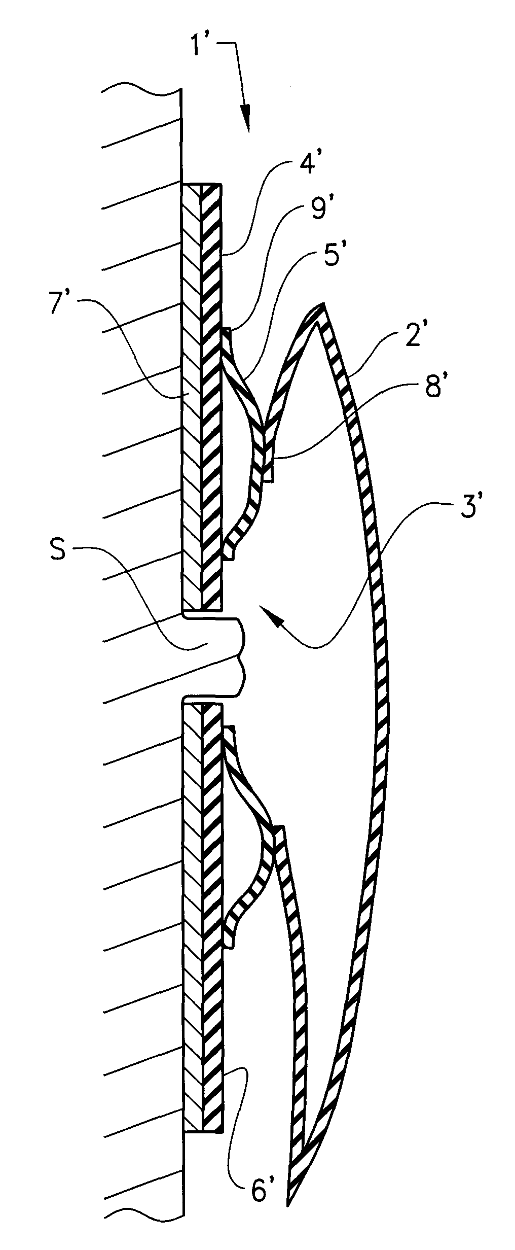 Ostomy device