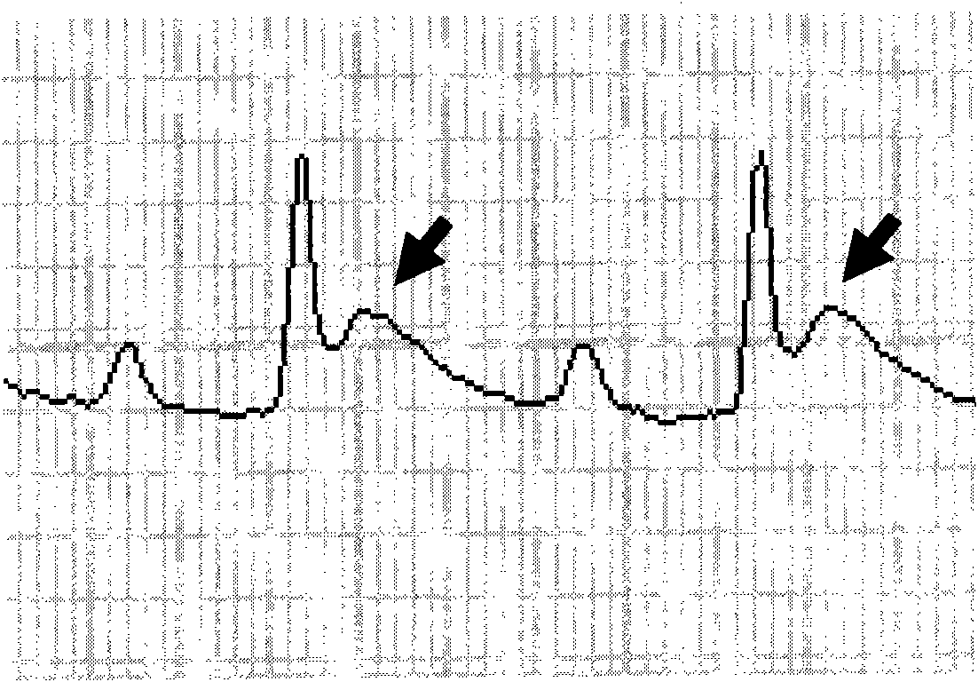 Tissue engineered cardiac muscle using OPF (Oligo(Poly(Ethylene Glycol) Fumarate) hydrogel as a carrier and preparation method thereof