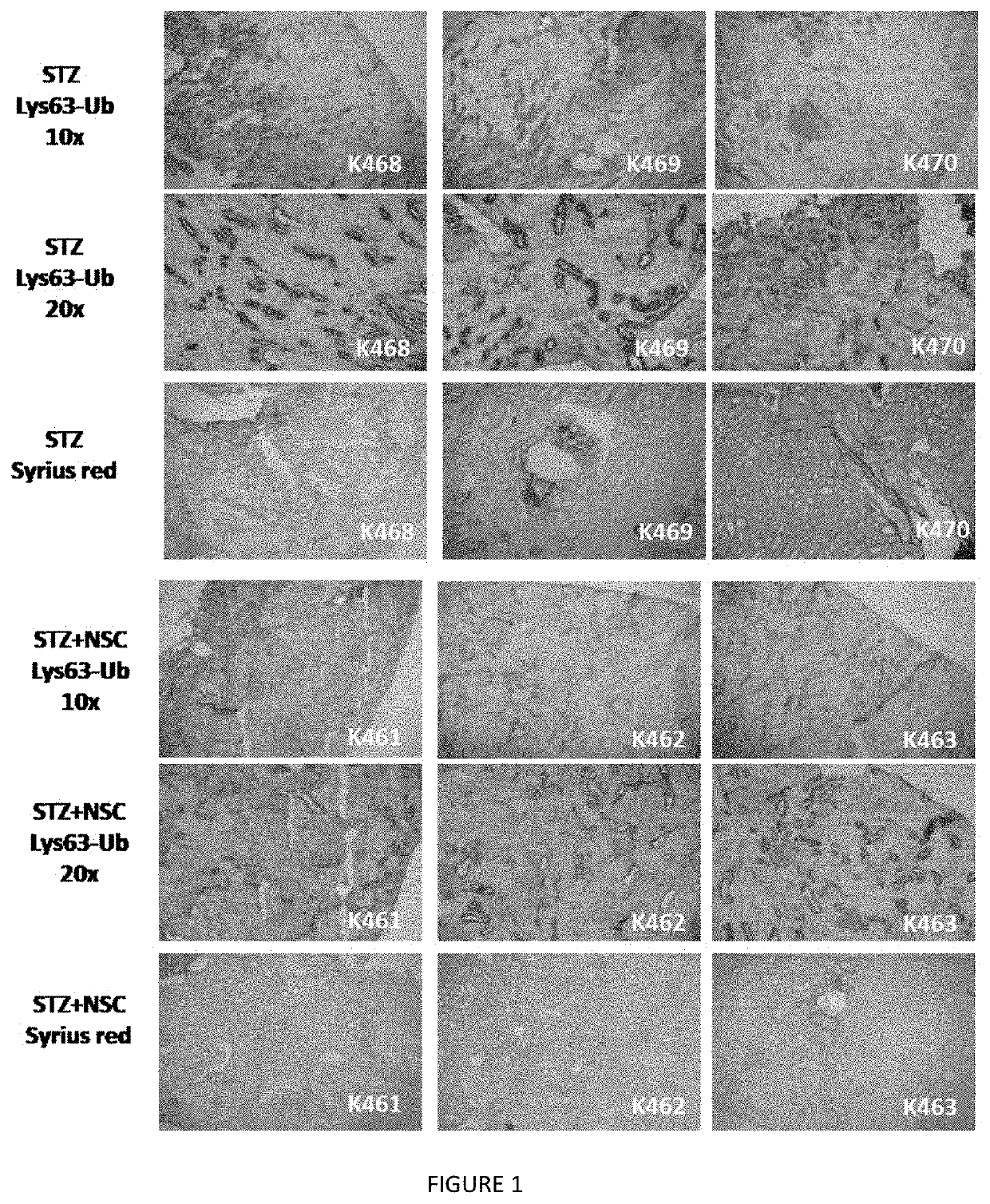 Combination of a ubiquitin-conjugating enzyme complex inhibitor and antihypertensive and/or hypoglycemic drugs in diabetic kidney disease