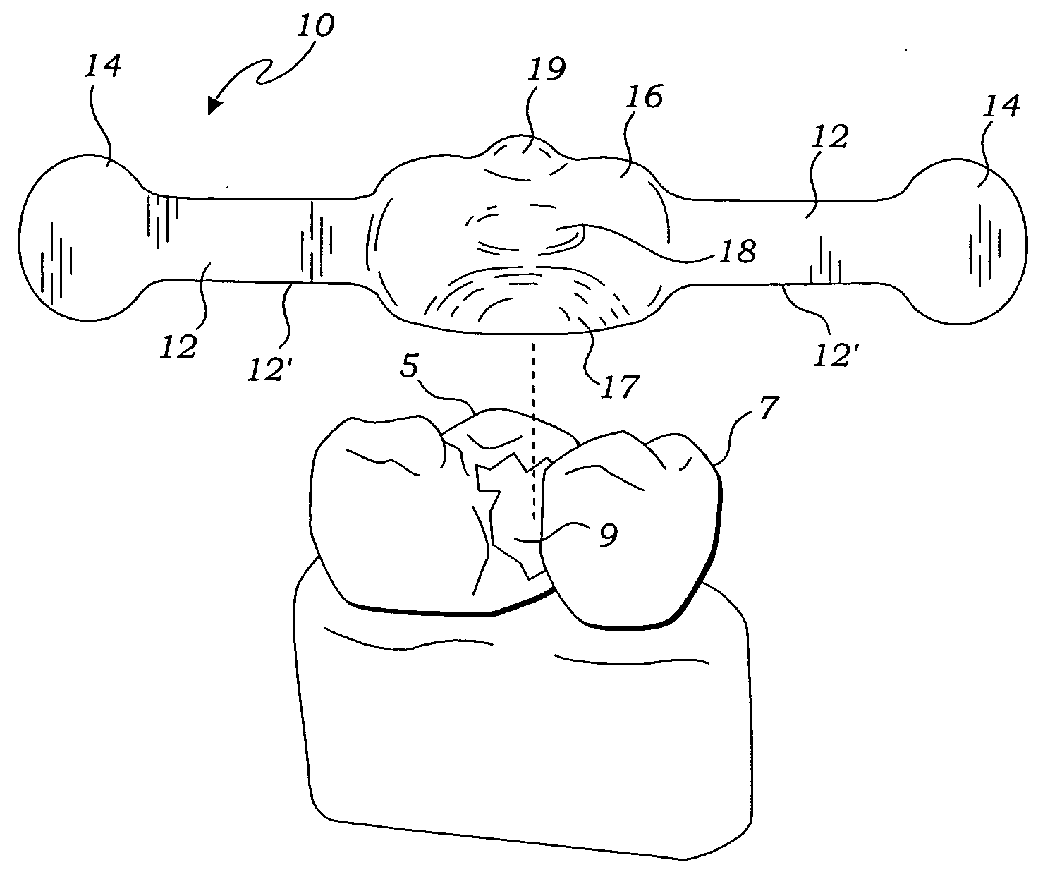 Matrix wedge restorative dental system and method of use