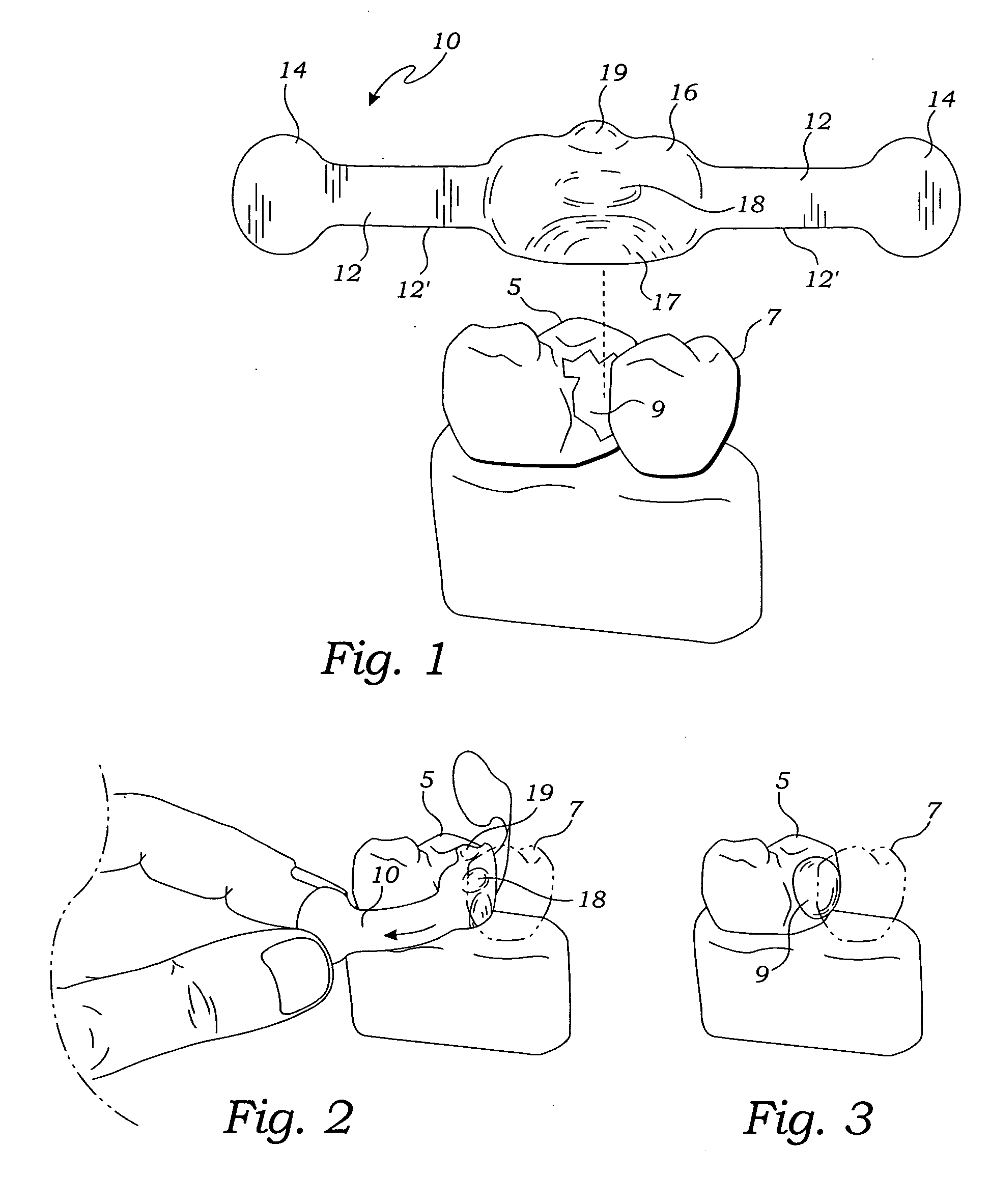 Matrix wedge restorative dental system and method of use