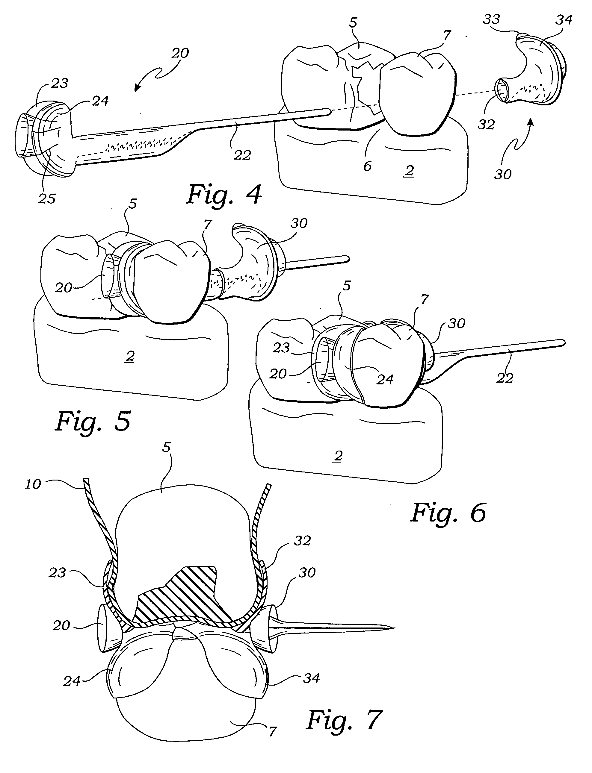 Matrix wedge restorative dental system and method of use