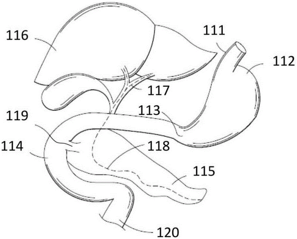 Intragastric device for treating obesity