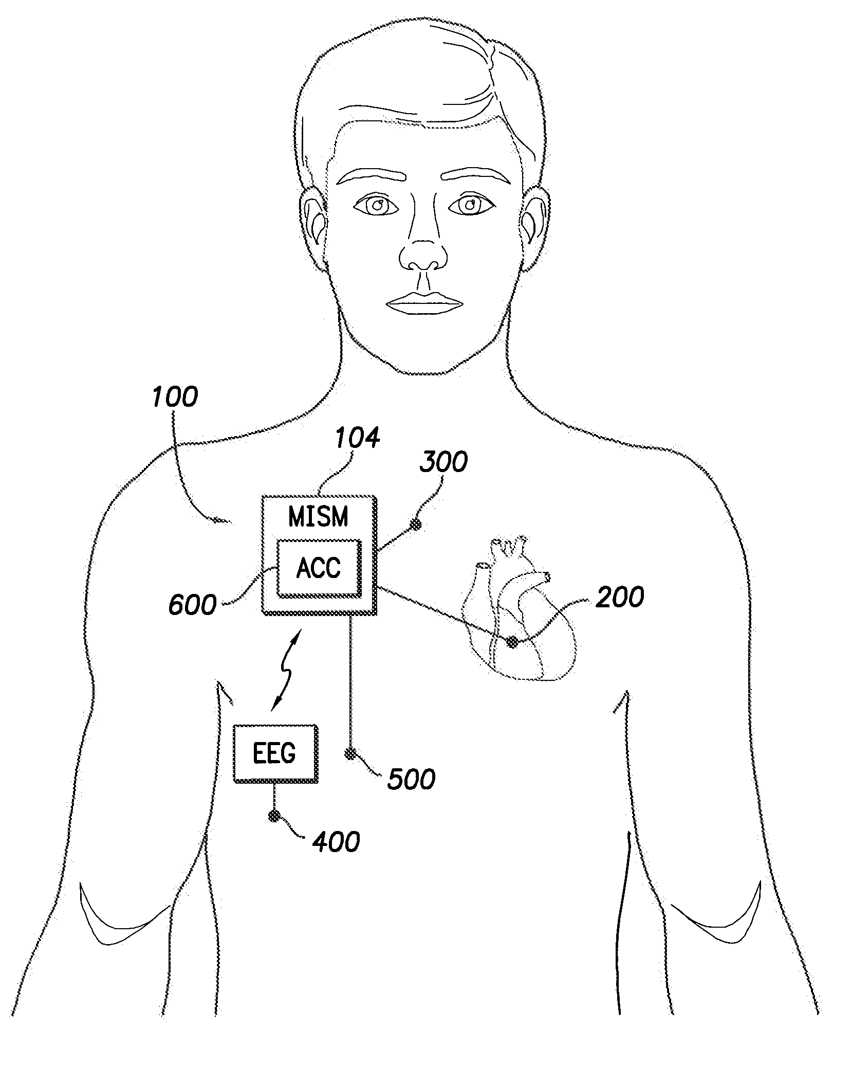 Multifaceted implantable syncope monitor - mism