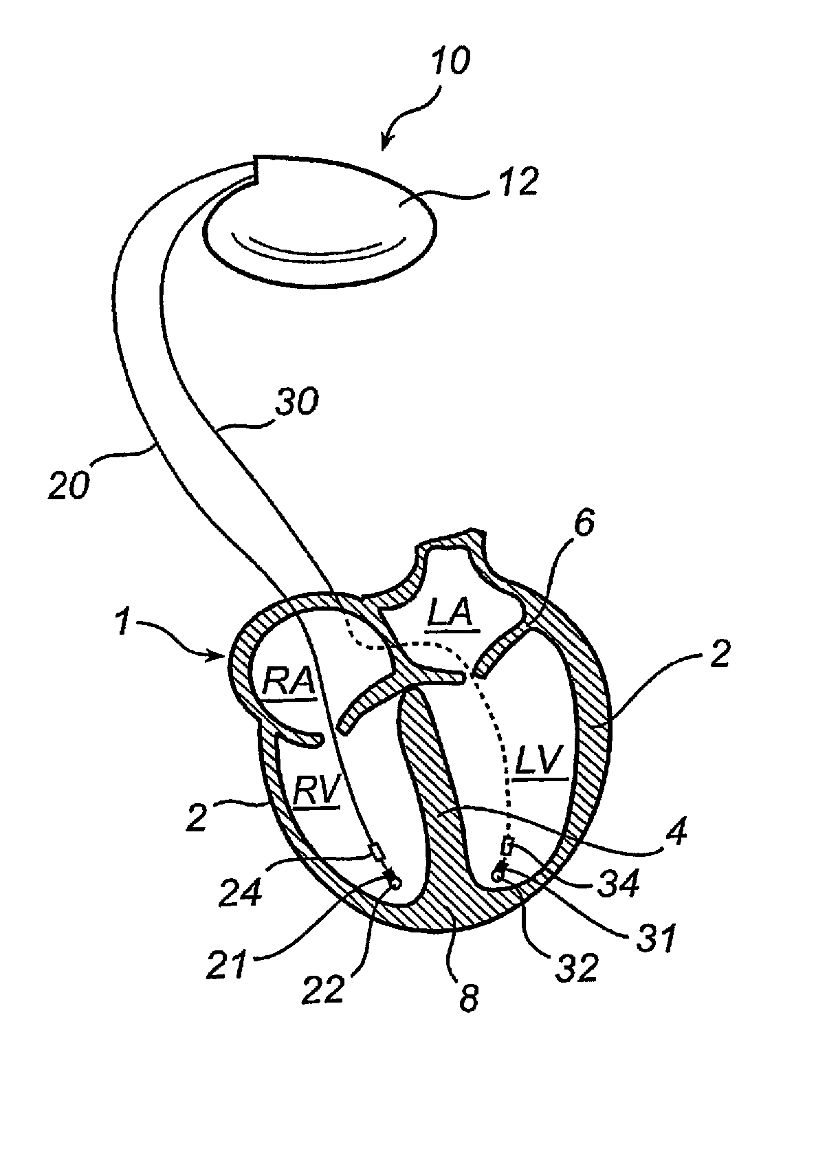 Implantable cardiac stimulator, system, device and method for monitoring cardiac synchrony